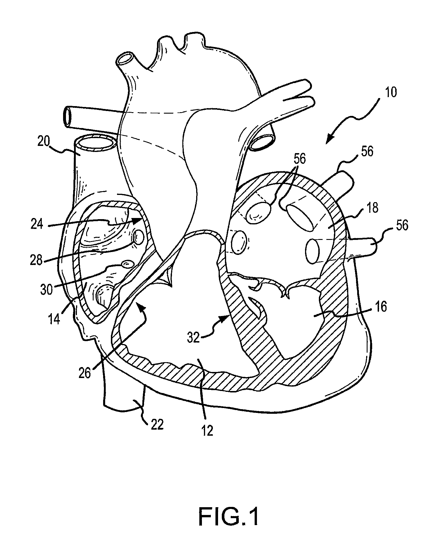 Medical device with flexible printed circuit