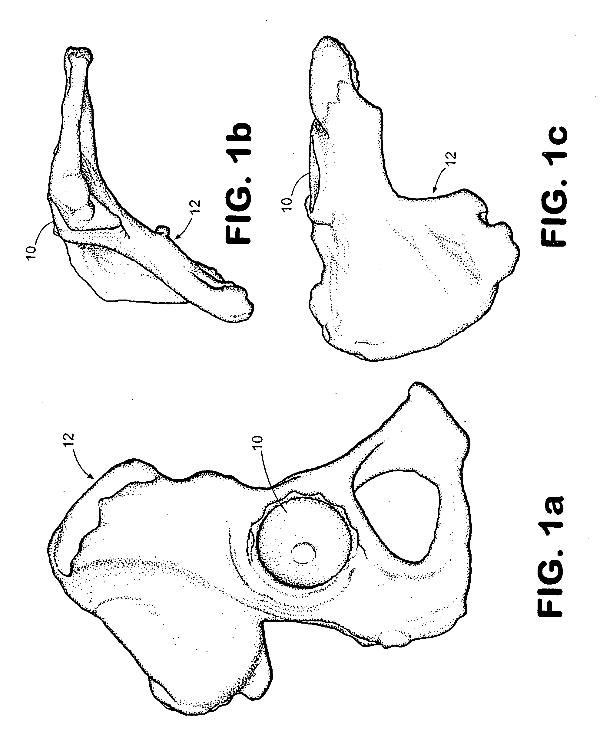 System and method of designing and manufacturing customized instrumentation for accurate implantation of prosthesis by utilizing computed tomography data