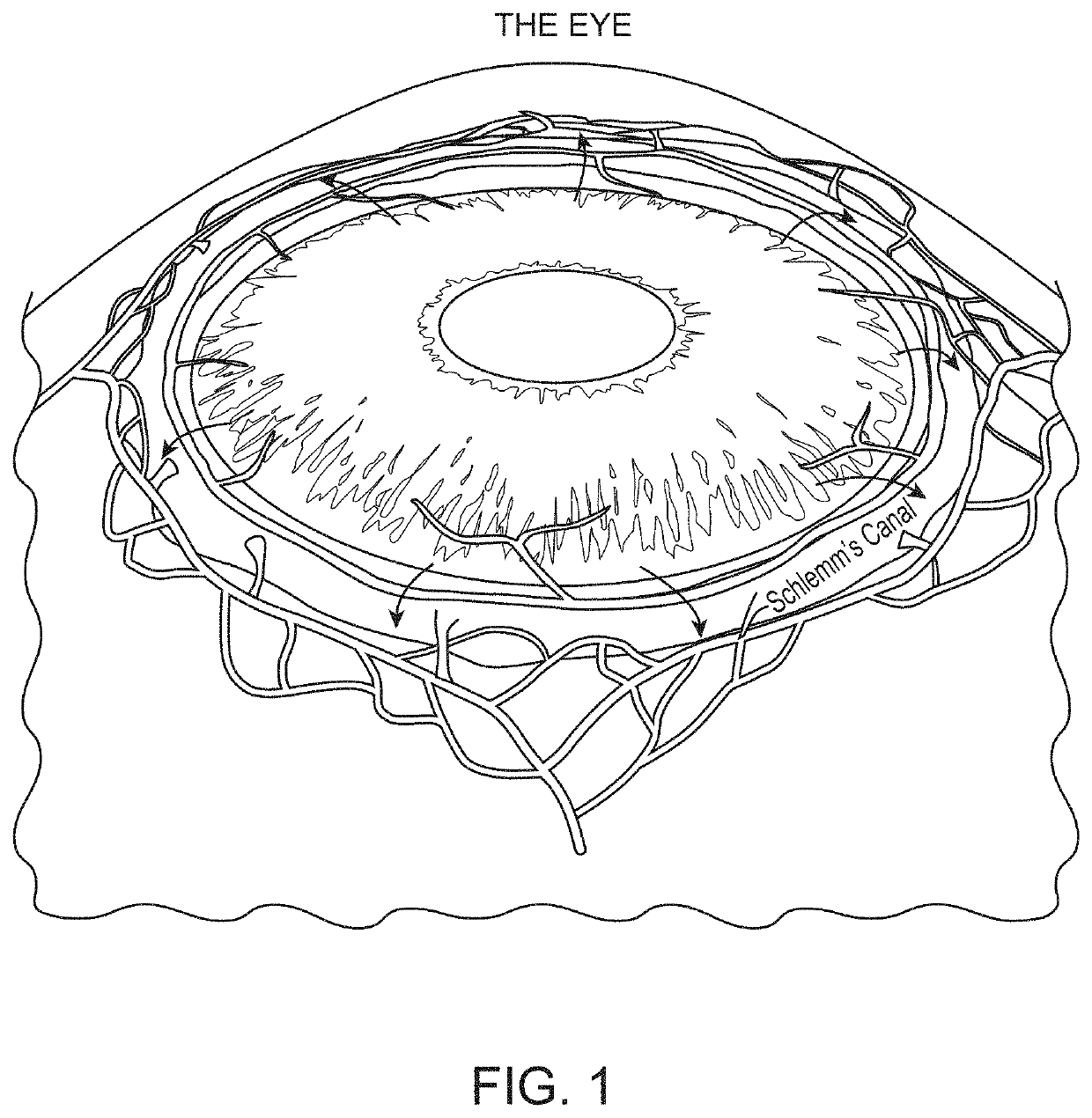 Eye stents and delivery systems