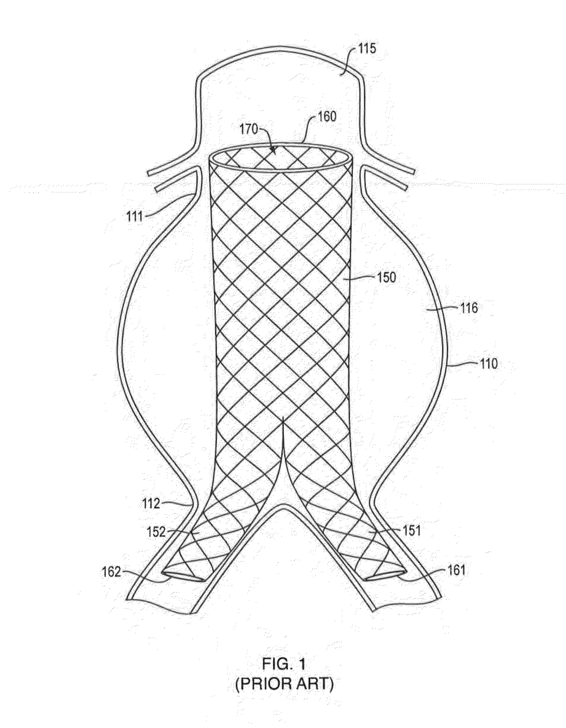 In-situ Forming foams with outer layer