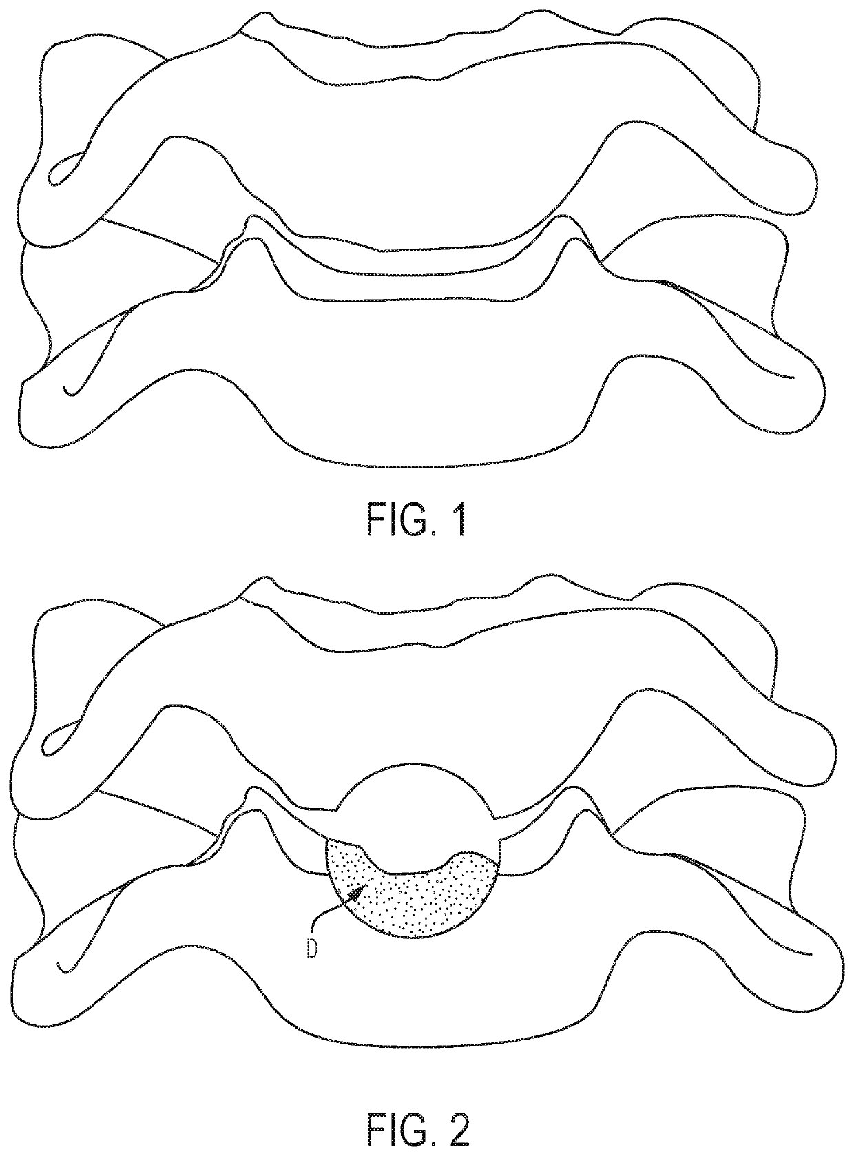 Cloward-style cervical mesh cage with lateral stabilizers