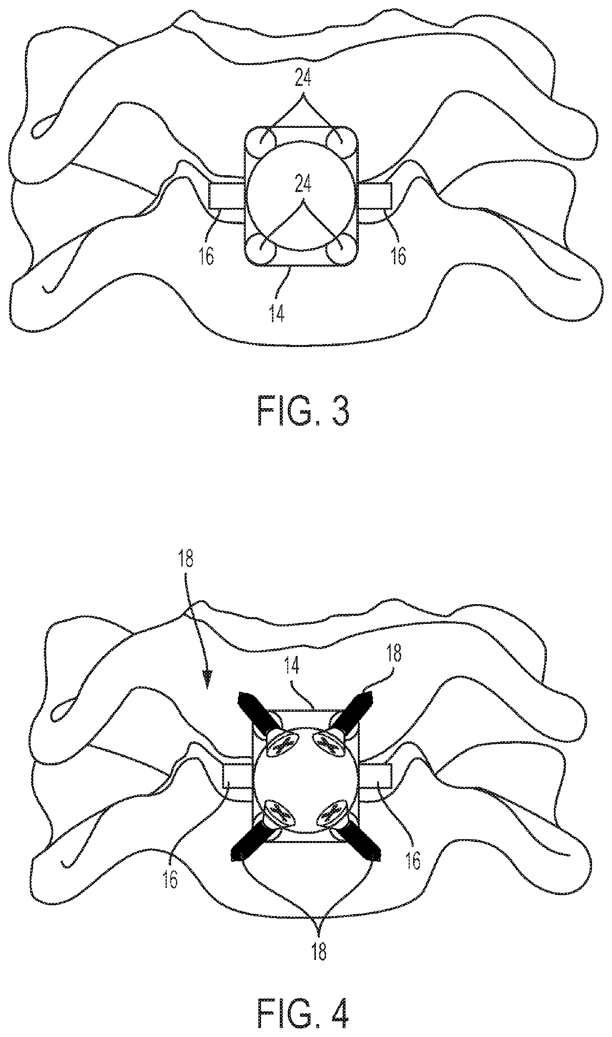 Cloward-style cervical mesh cage with lateral stabilizers