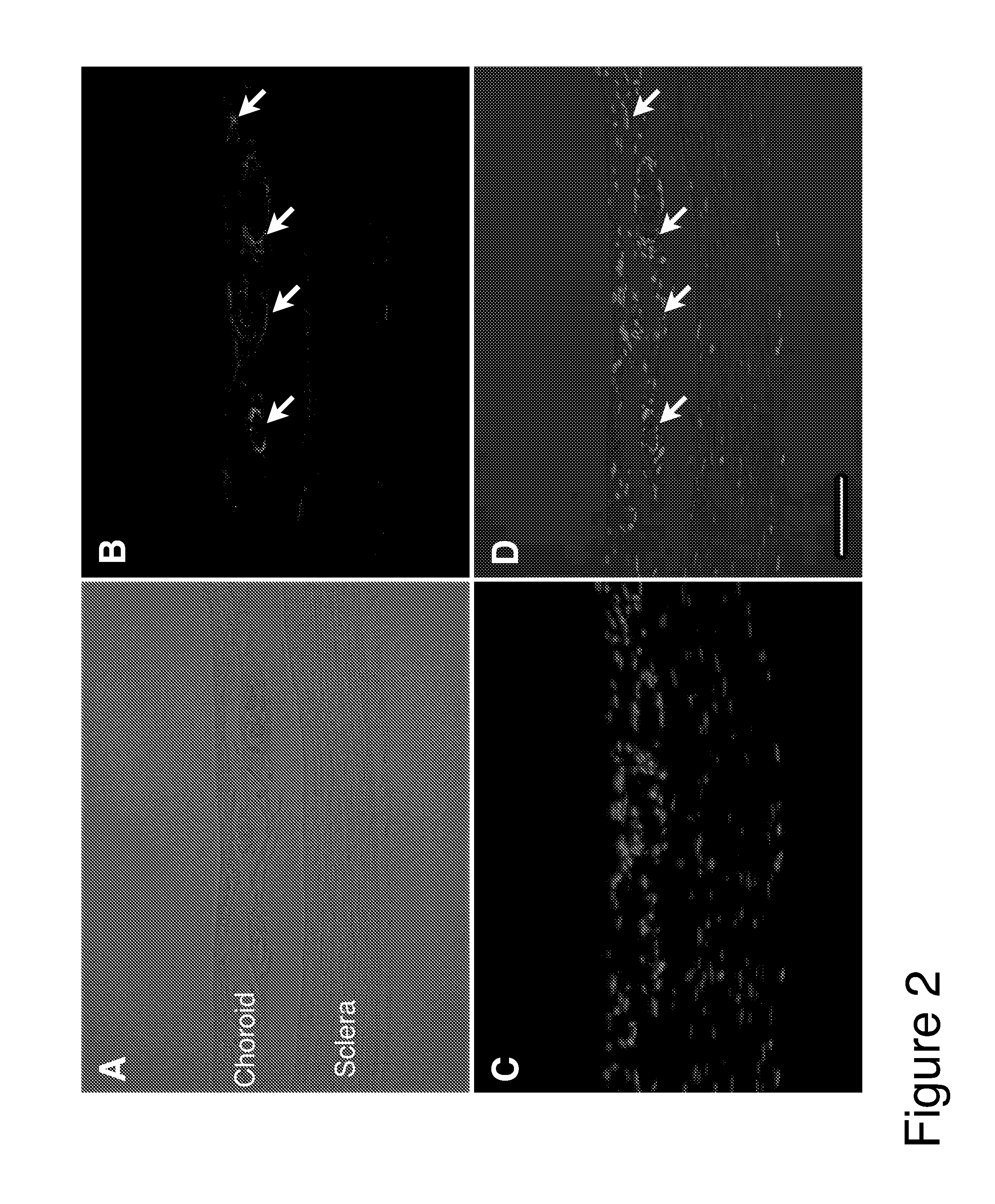 Methods and compositions for treating conditions associated with angiogenesis using a vascular adhesion protein-1 (vap-1) inhibitor