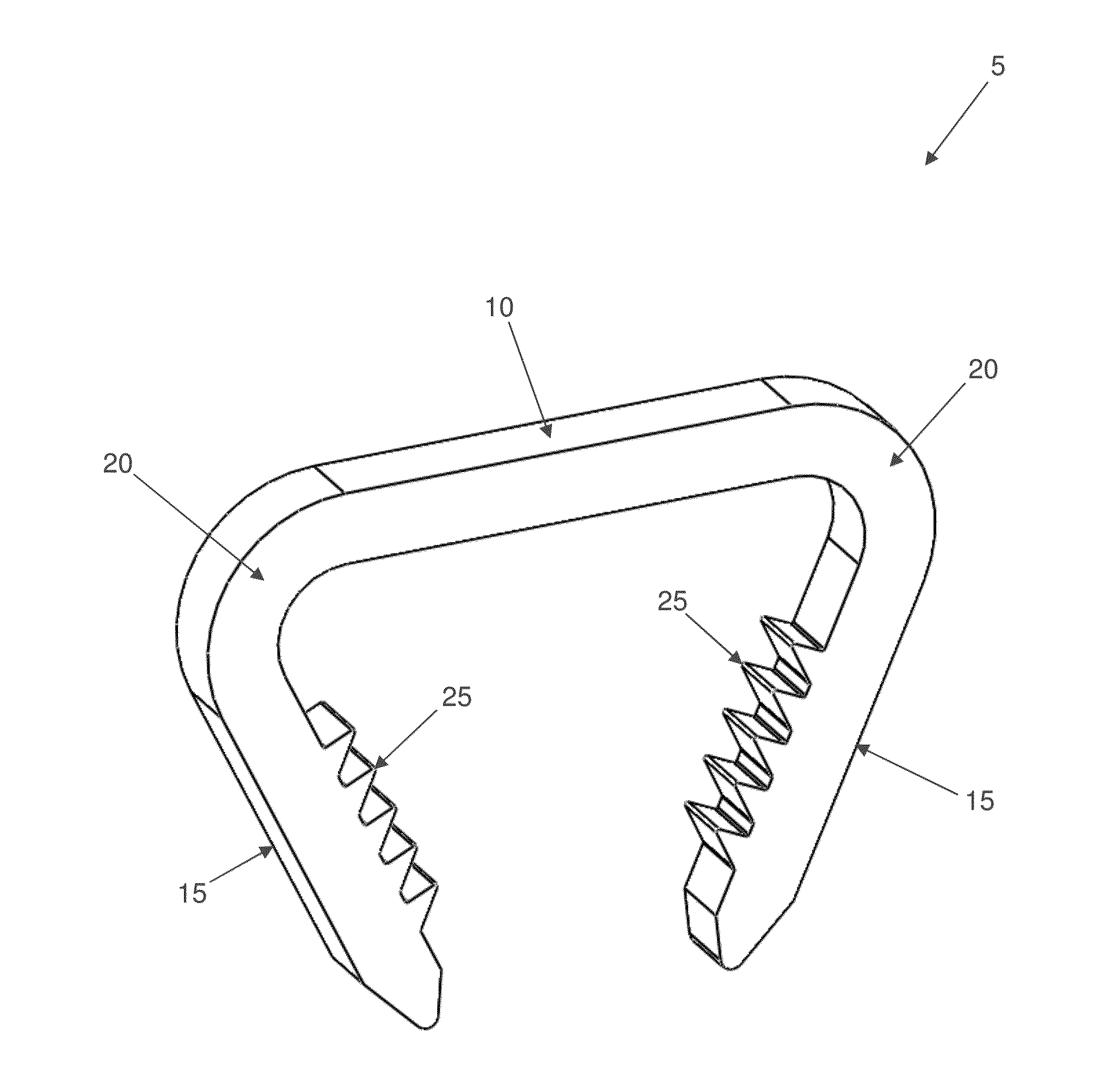 Staples for generating and applying compression within a body