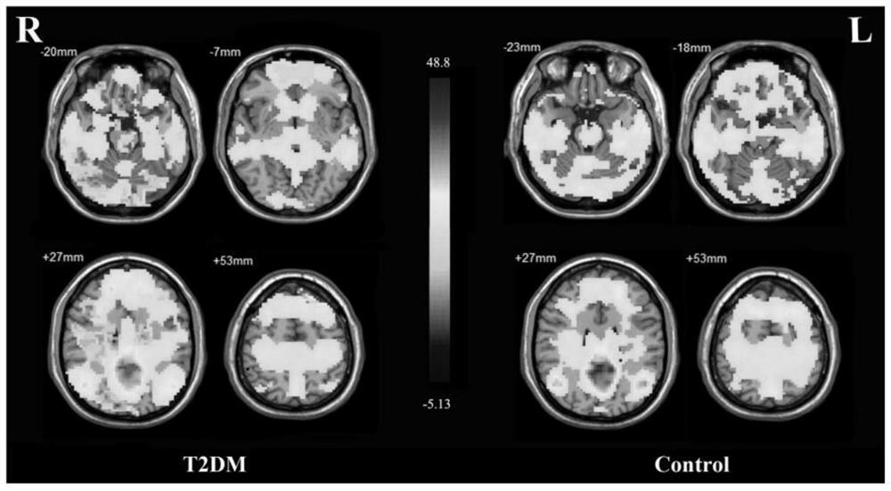 A feature extraction method for posterior cingulate functional connectivity associated with cognitive impairment in patients with type 2 diabetes mellitus
