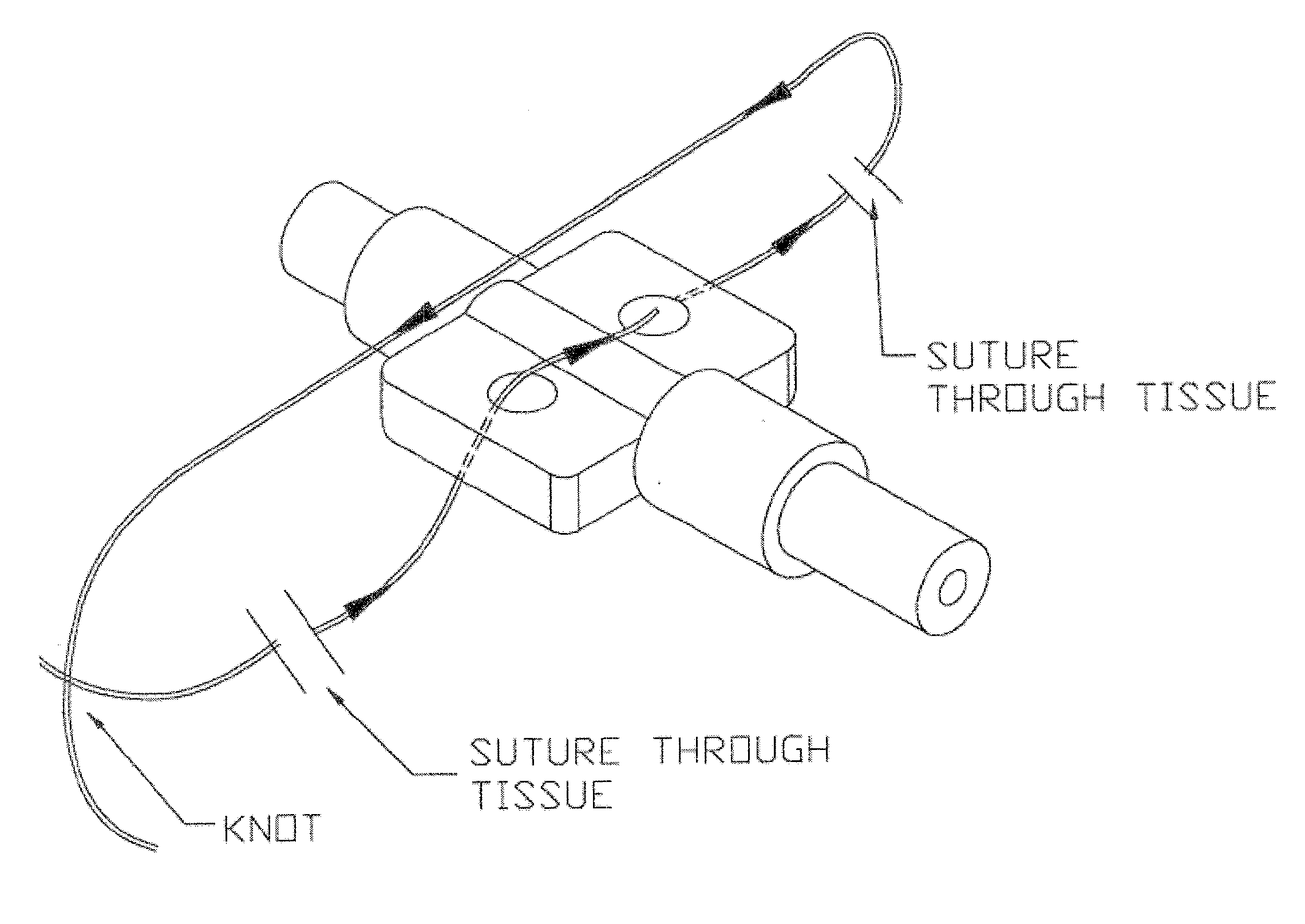 Implant Device for Use in Salivary Gland Duct