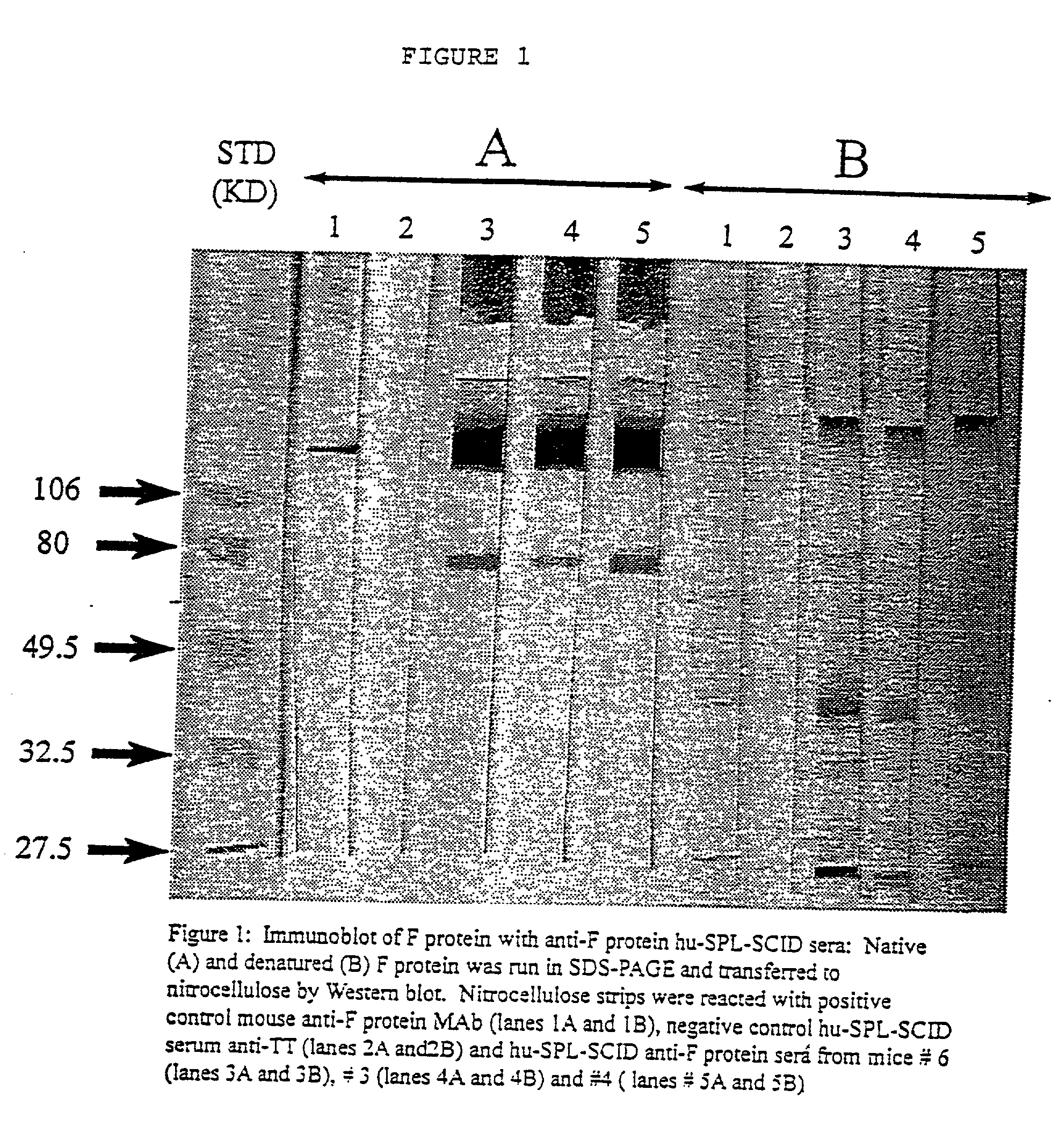 Neutralizing high affinity human monoclonal antibodies specific to rsv f-protein and methods for their manufacture and theraputic use thereof