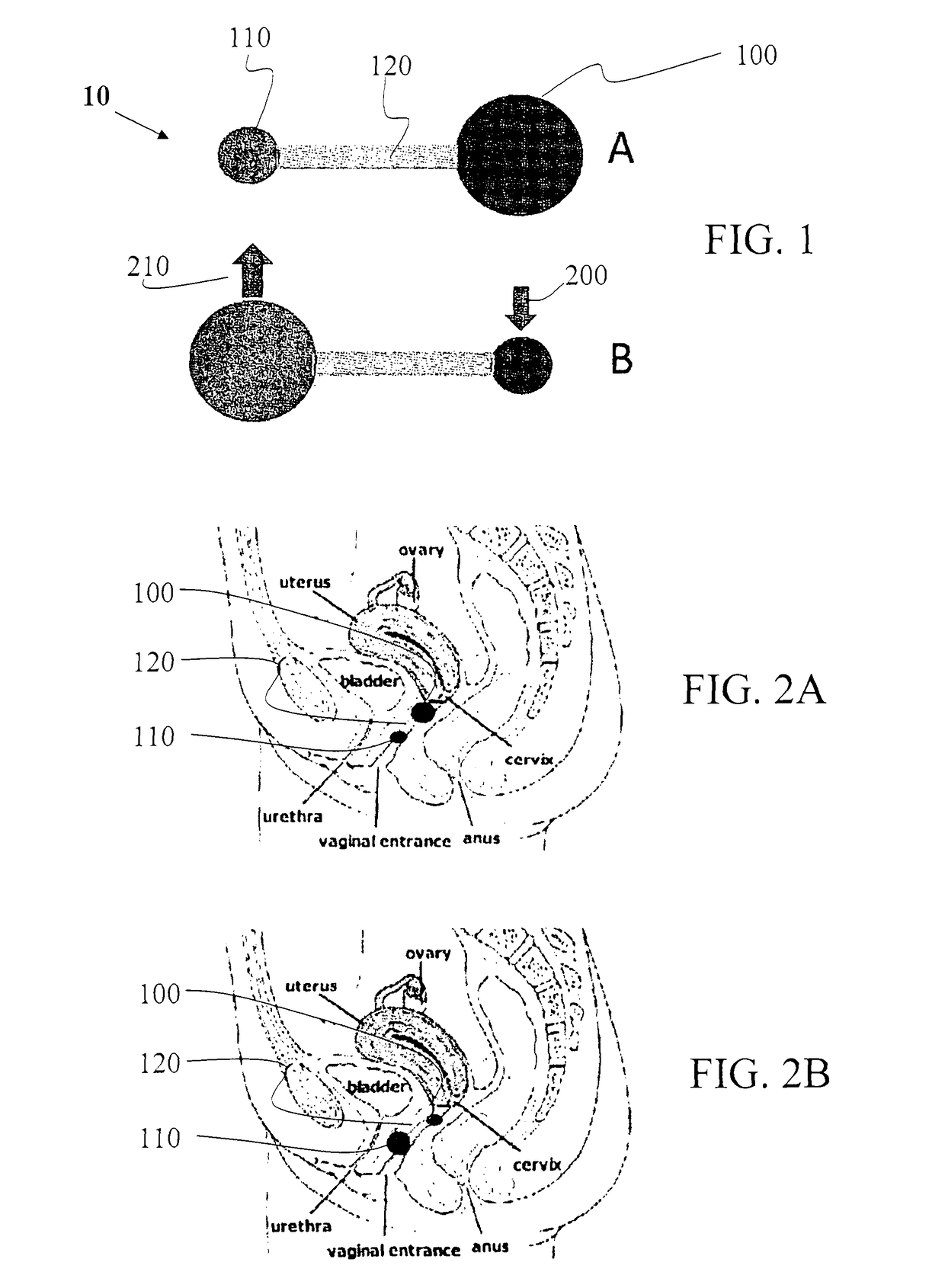Medical device for treatment of urinary incontinence in females