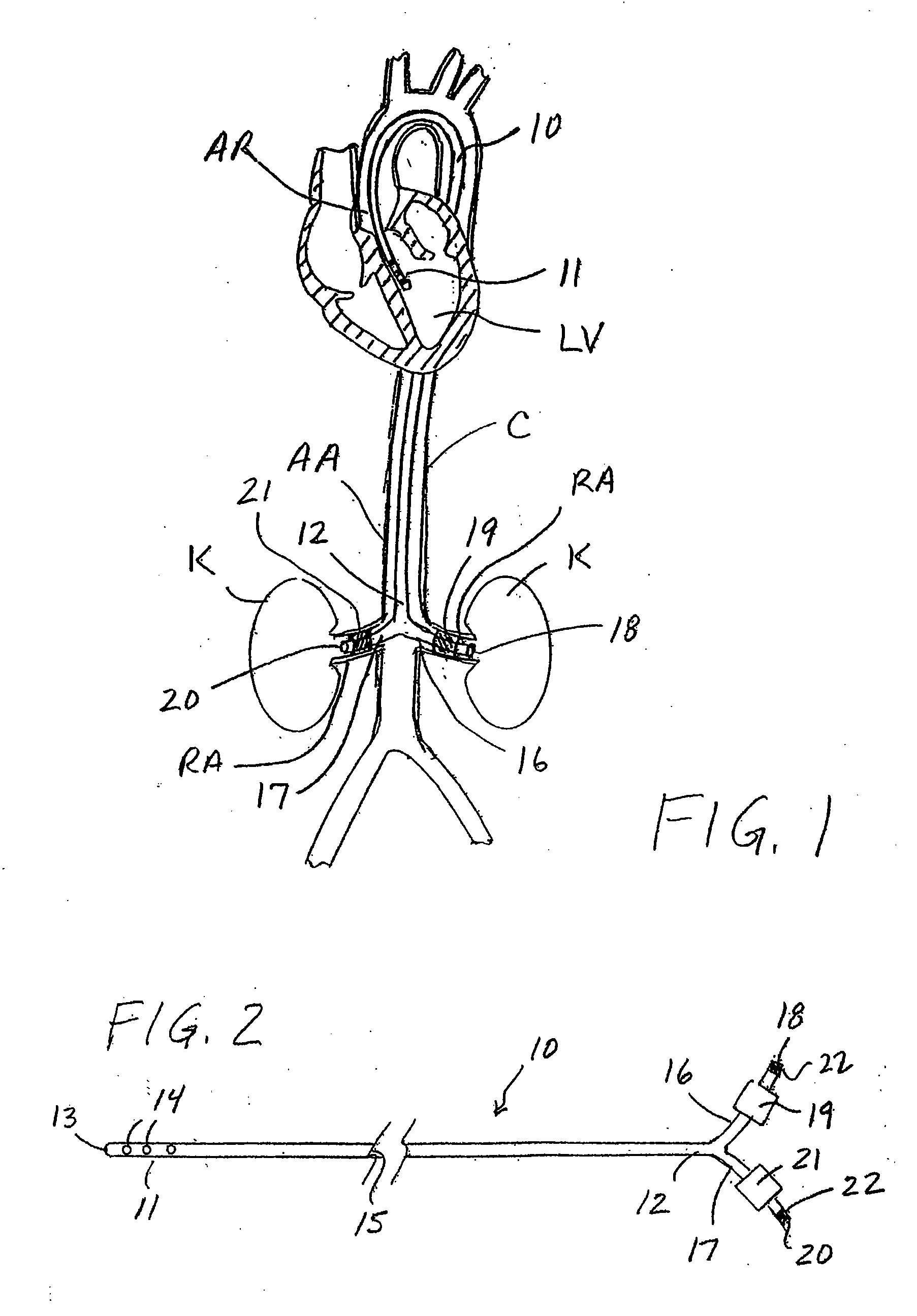 Apparatus and methods for treating congestive heart disease