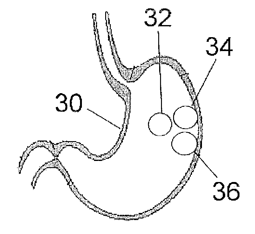 Self-inflating and deflating intragastric balloon implant device