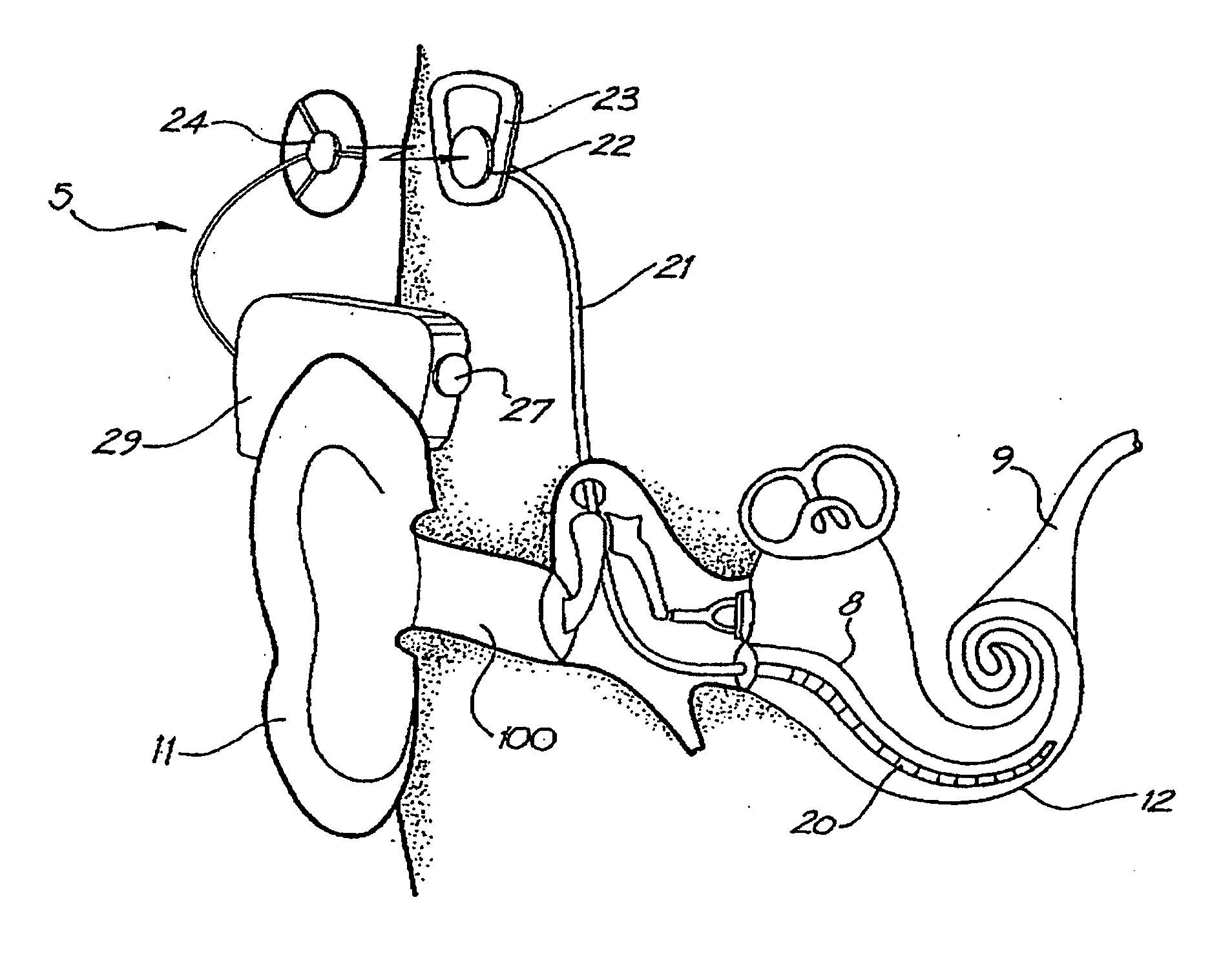 General purpose accessory for a cochlear implant system