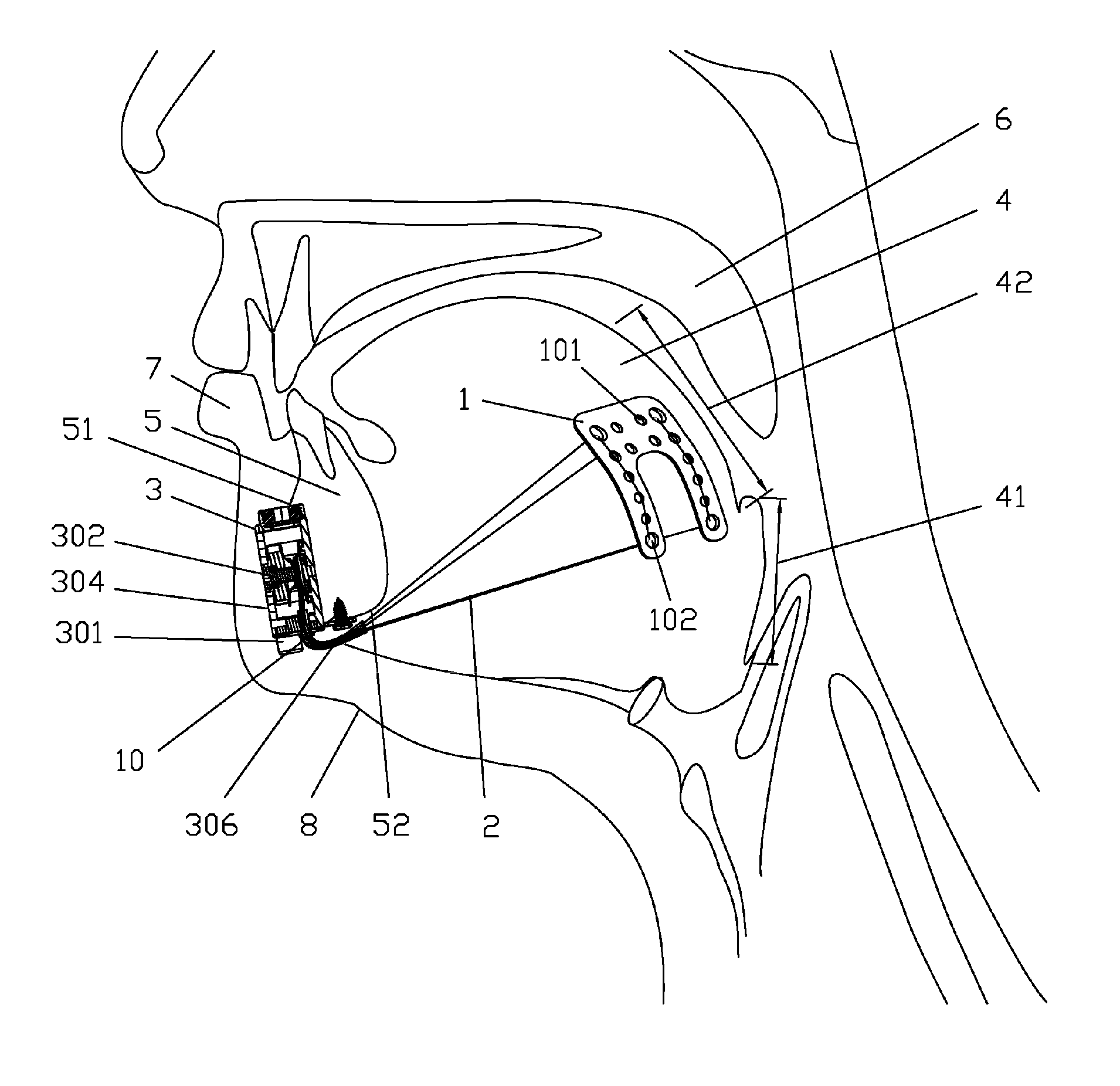 Implanted Tongue Pulling Device, Pull Plate, Pull Line, Retractor And Method