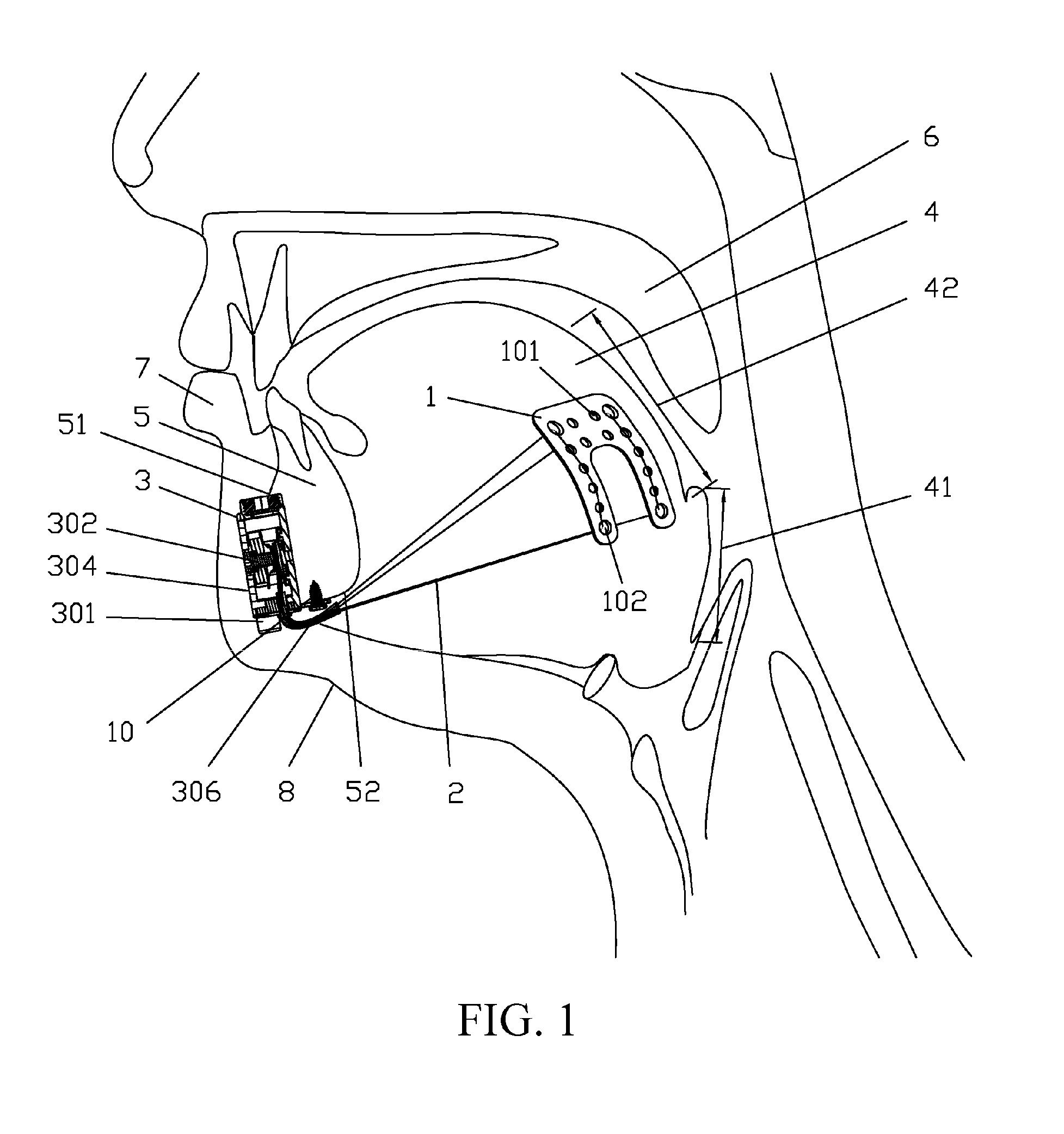 Implanted Tongue Pulling Device, Pull Plate, Pull Line, Retractor And Method