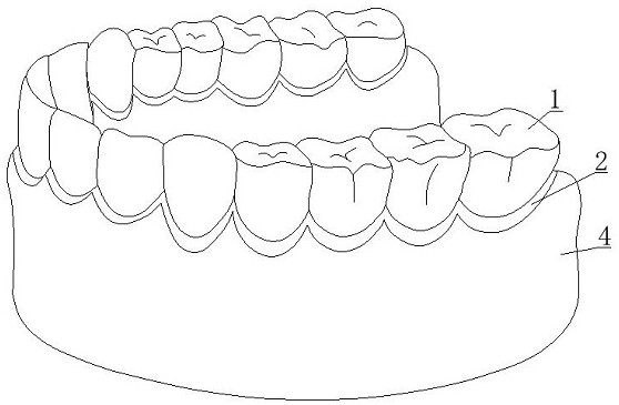 A spliced ​​metal denture and manufacturing method thereof