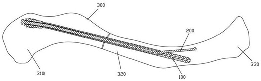 Intramedullary fixation device for clavicle fracture