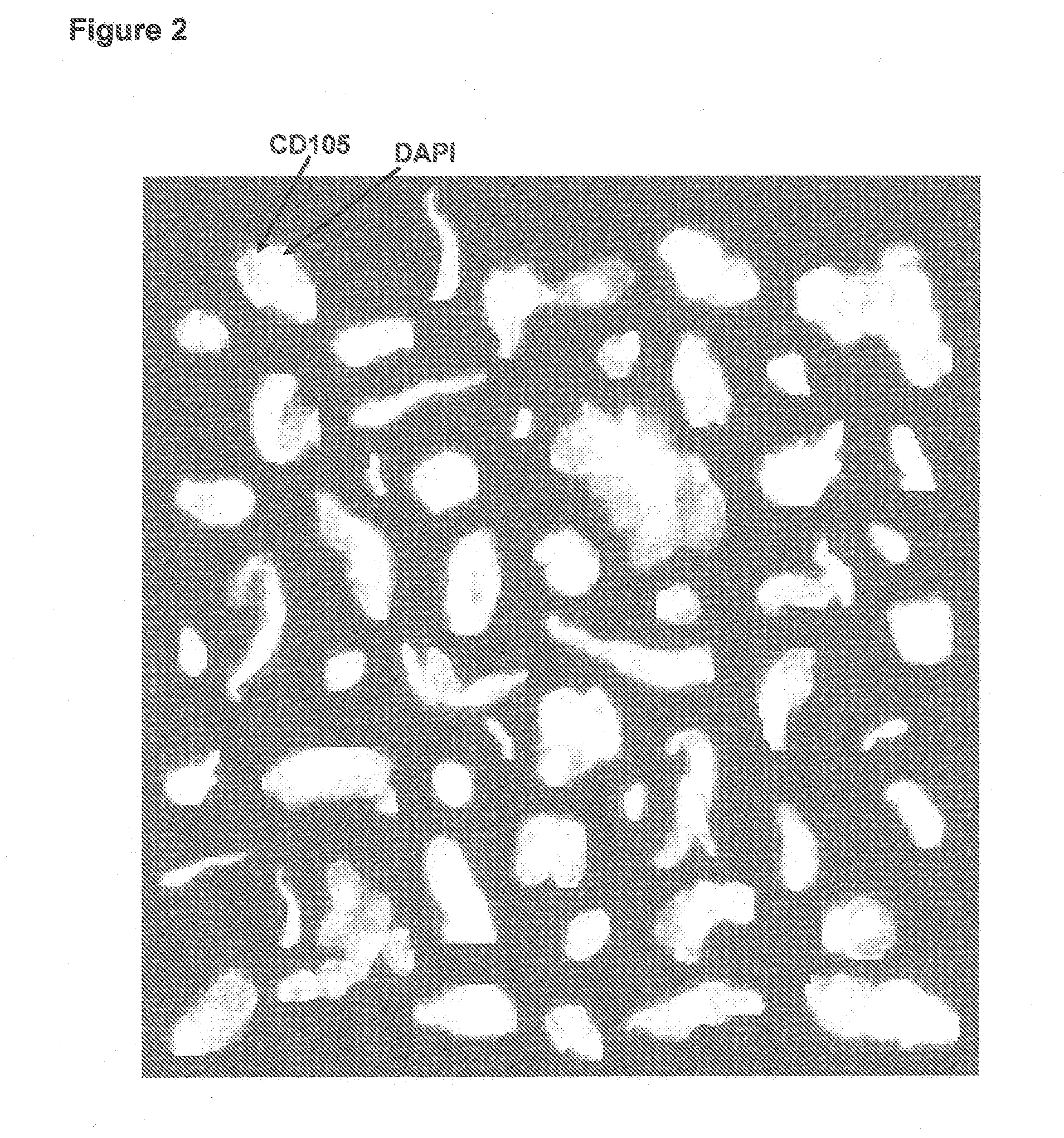 Method of assessing metastatic carcinomas from circulating endothelial cells and disseminated tumor cells