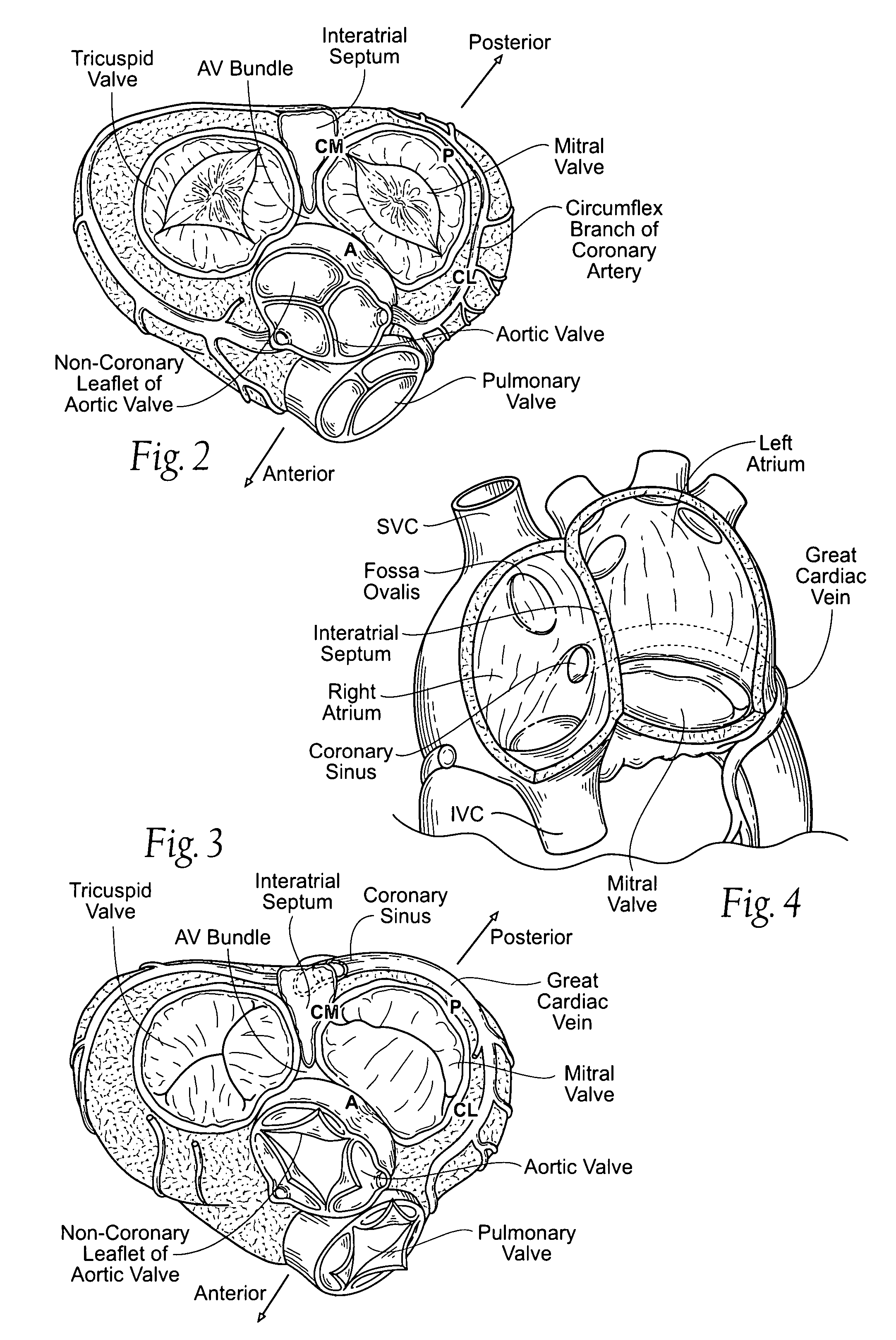 Devices, systems, and methods for reshaping a heart valve annulus, including the use of magnetic tools