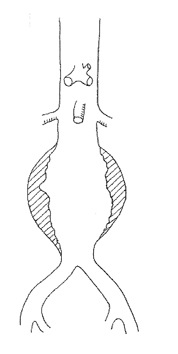 Treatment of aneurysm with application of connective tissue stabilization agent in combination with a delivery vehicle