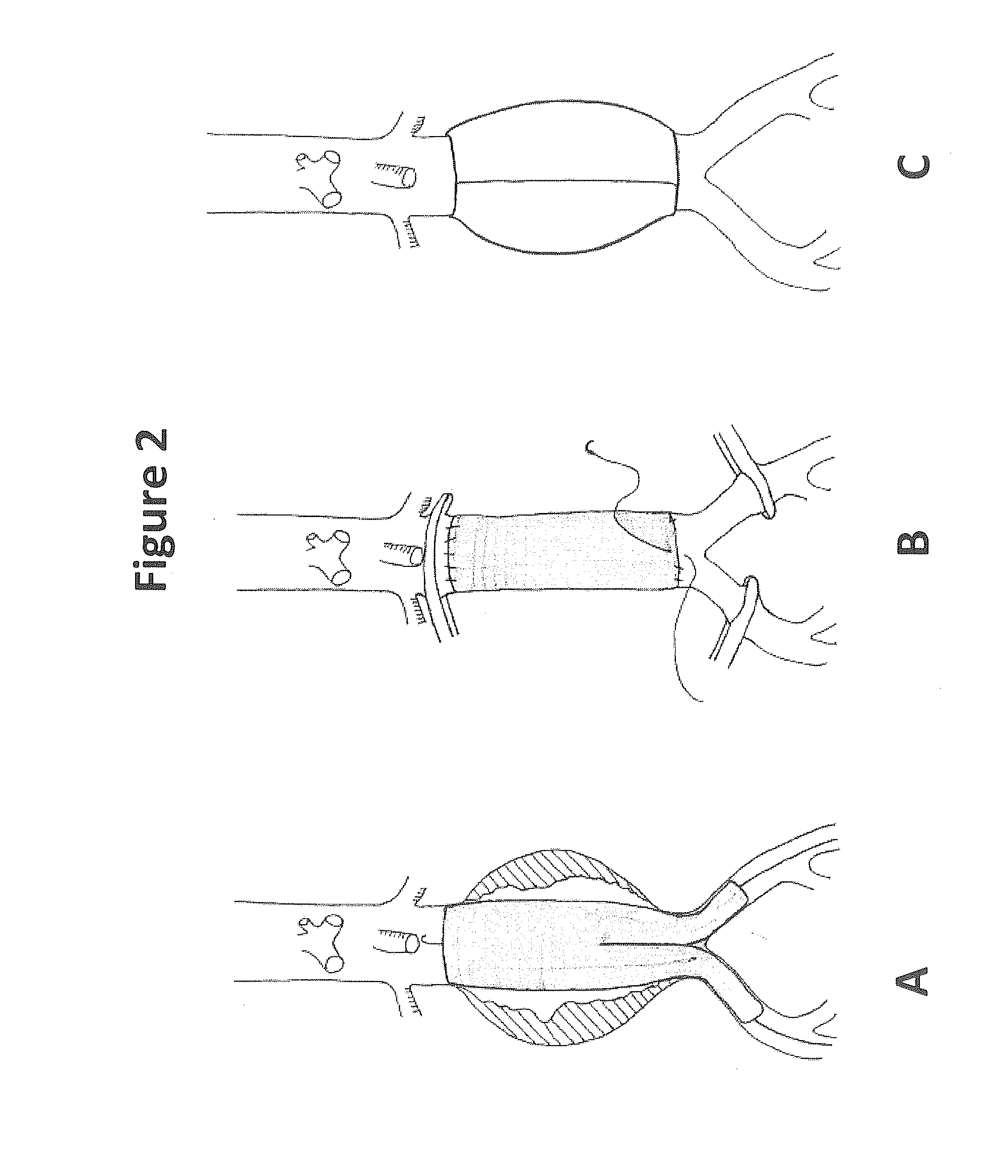 Treatment of aneurysm with application of connective tissue stabilization agent in combination with a delivery vehicle