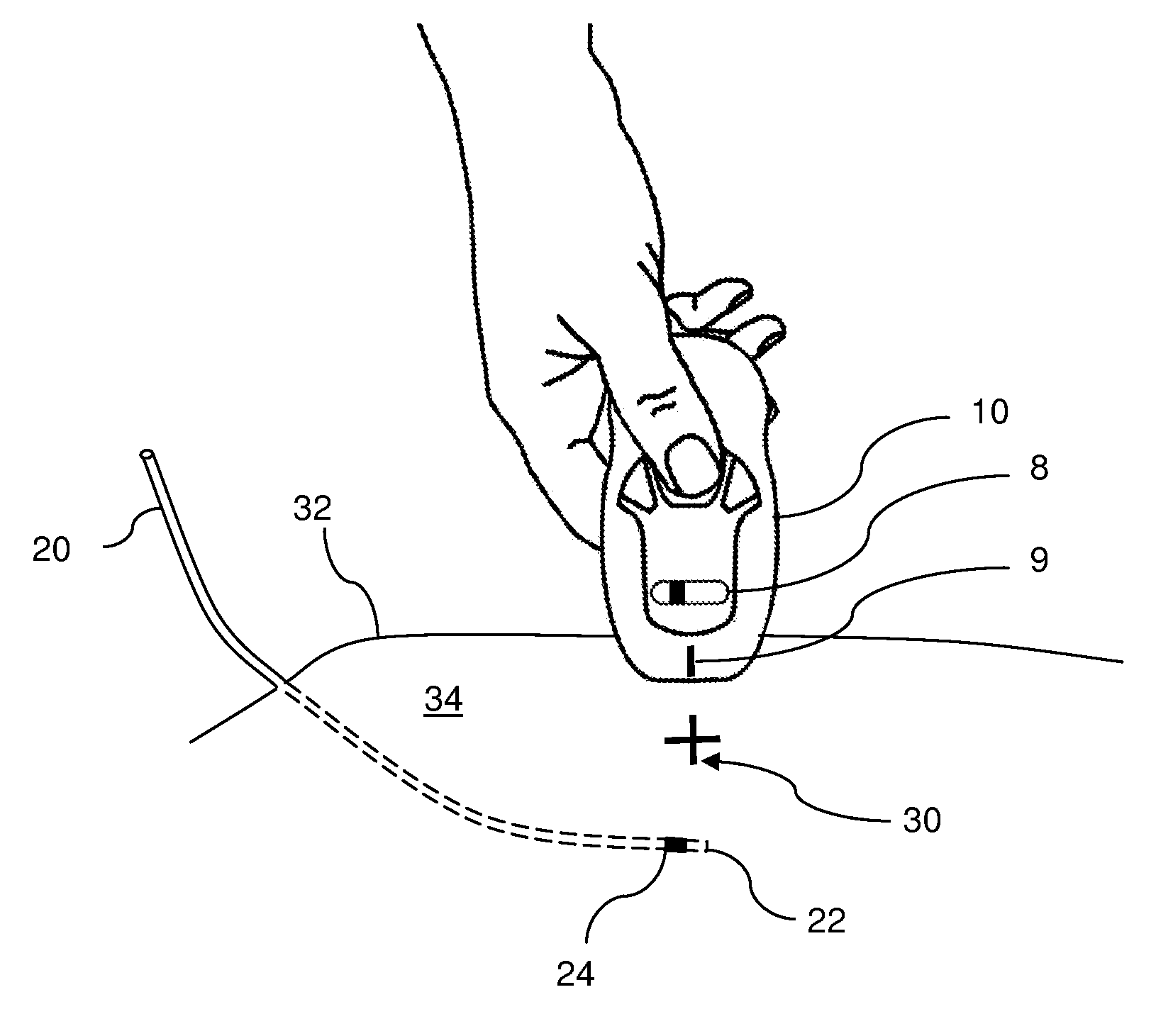 System for optically detecting position of an indwelling catheter