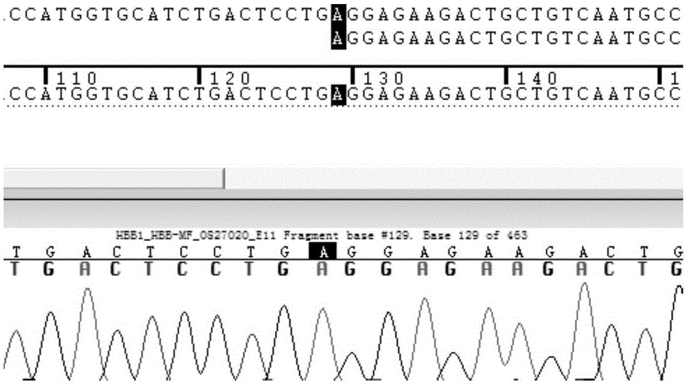 Gene detecting primers of sickle cell anemia and composition of gene detecting primers