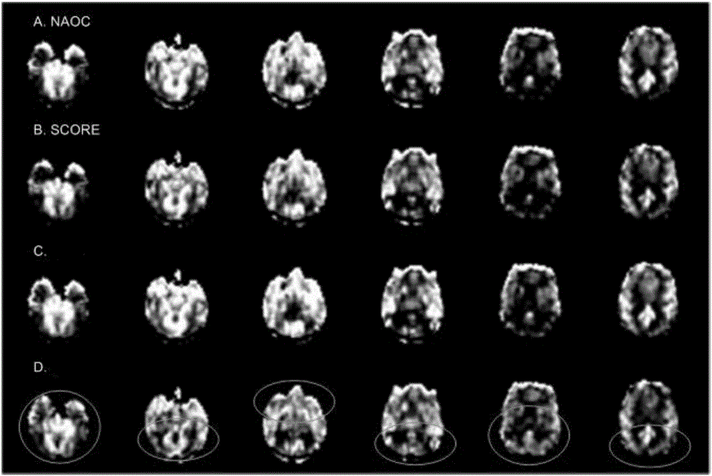 Magnetic resonance artery spin labeling cerebral perfusion imaging data artifact graph removal method