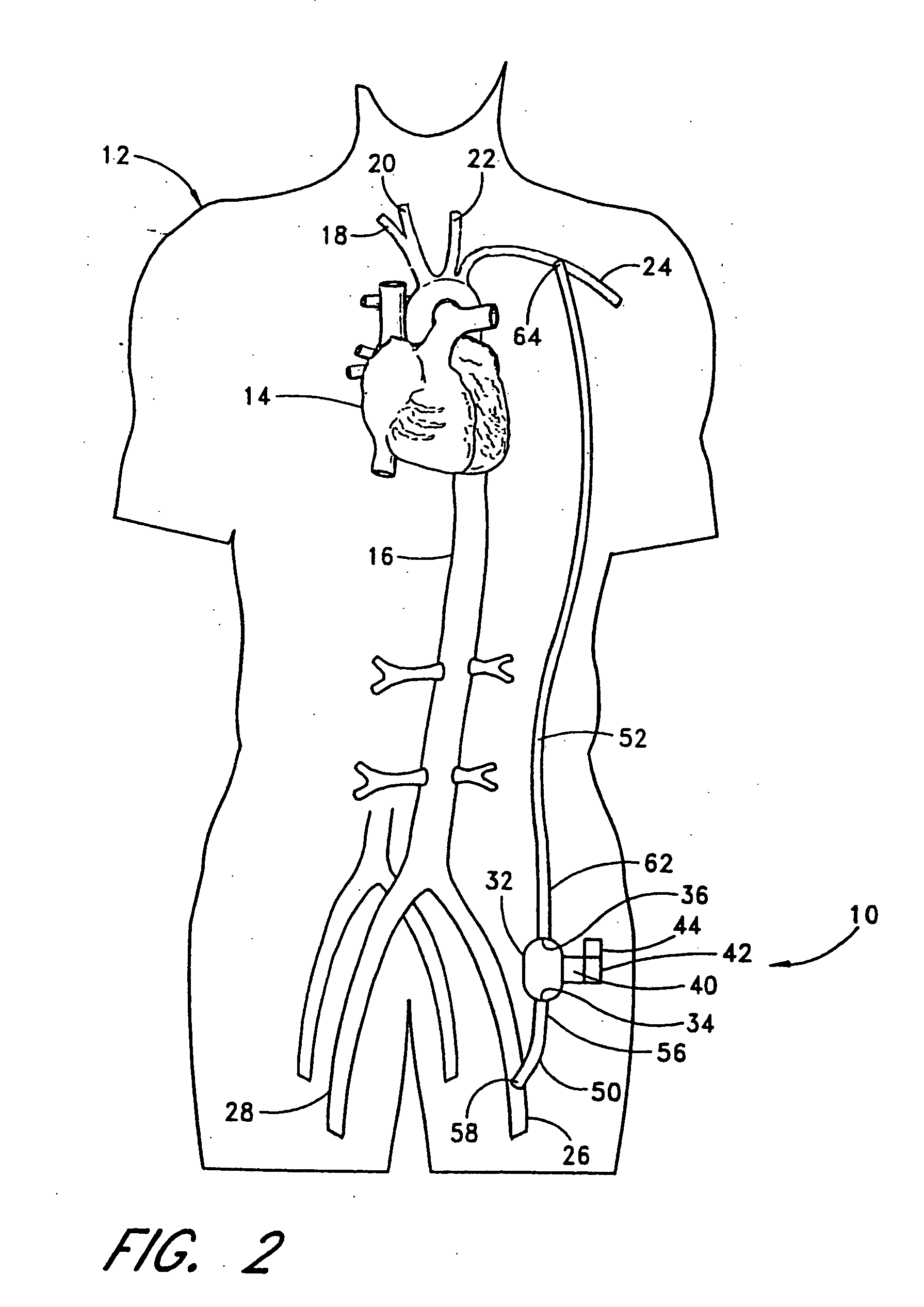 Implantable heart assist system and method of applying same