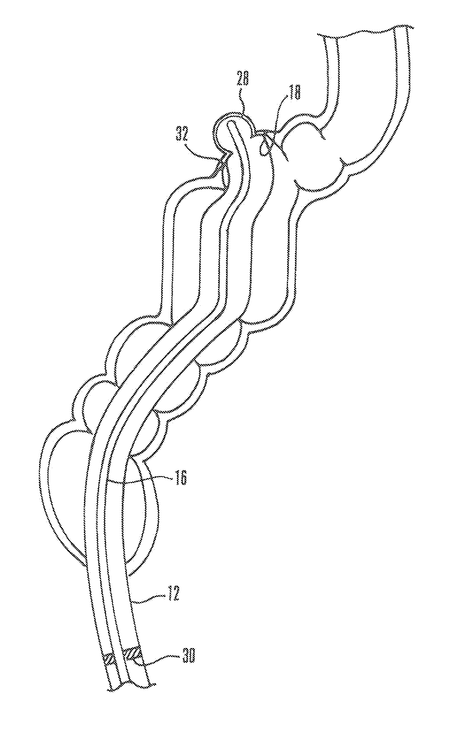 Systems and methods for endoscopic inversion and removal of diverticula
