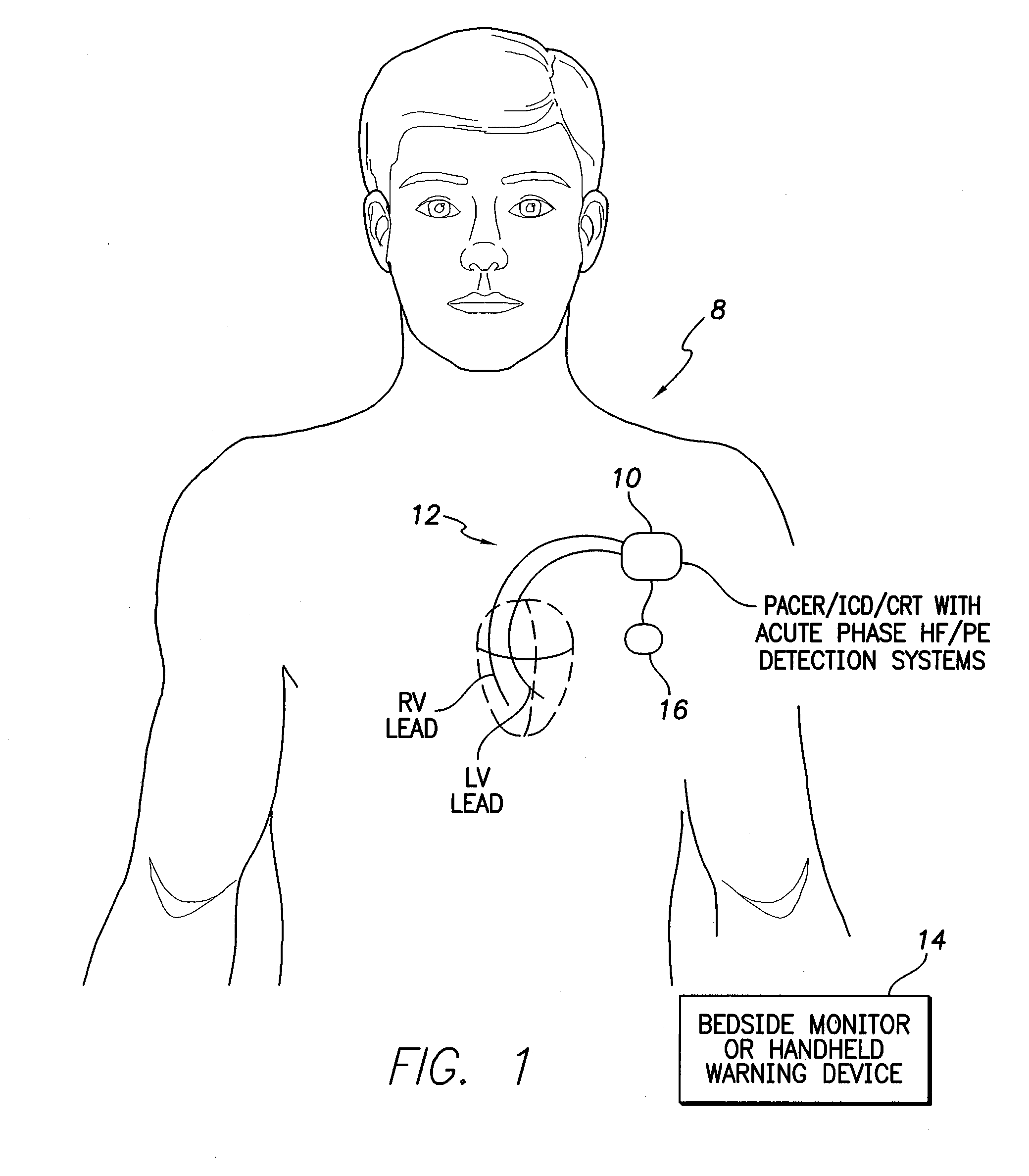 Systems and Methods for Activating and Controlling Impedance-Based Detection Systems of Implantable Medical Devices