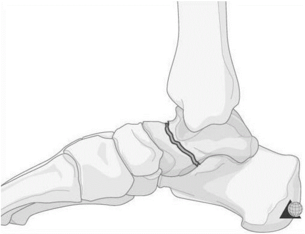 Talus anterolateral tarsal sinus approach miniature locking steel plate