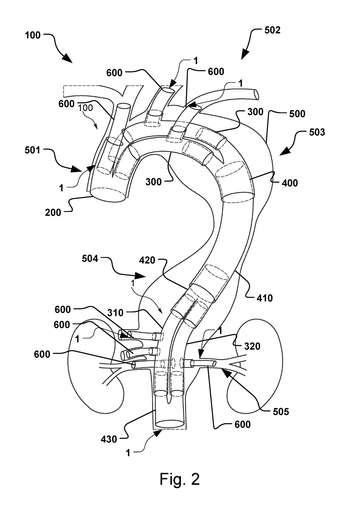 Vascular Medical Device, System And Method