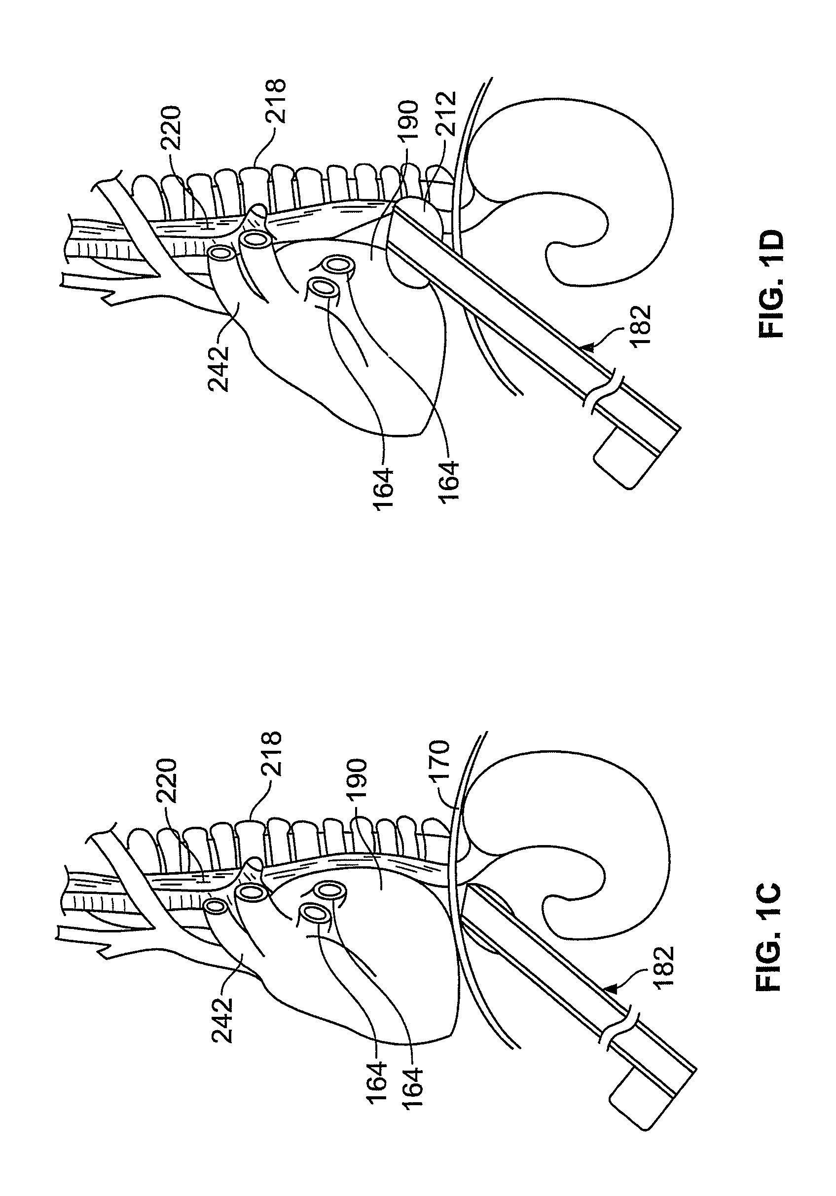 Diaphragm entry for posterior surgical access