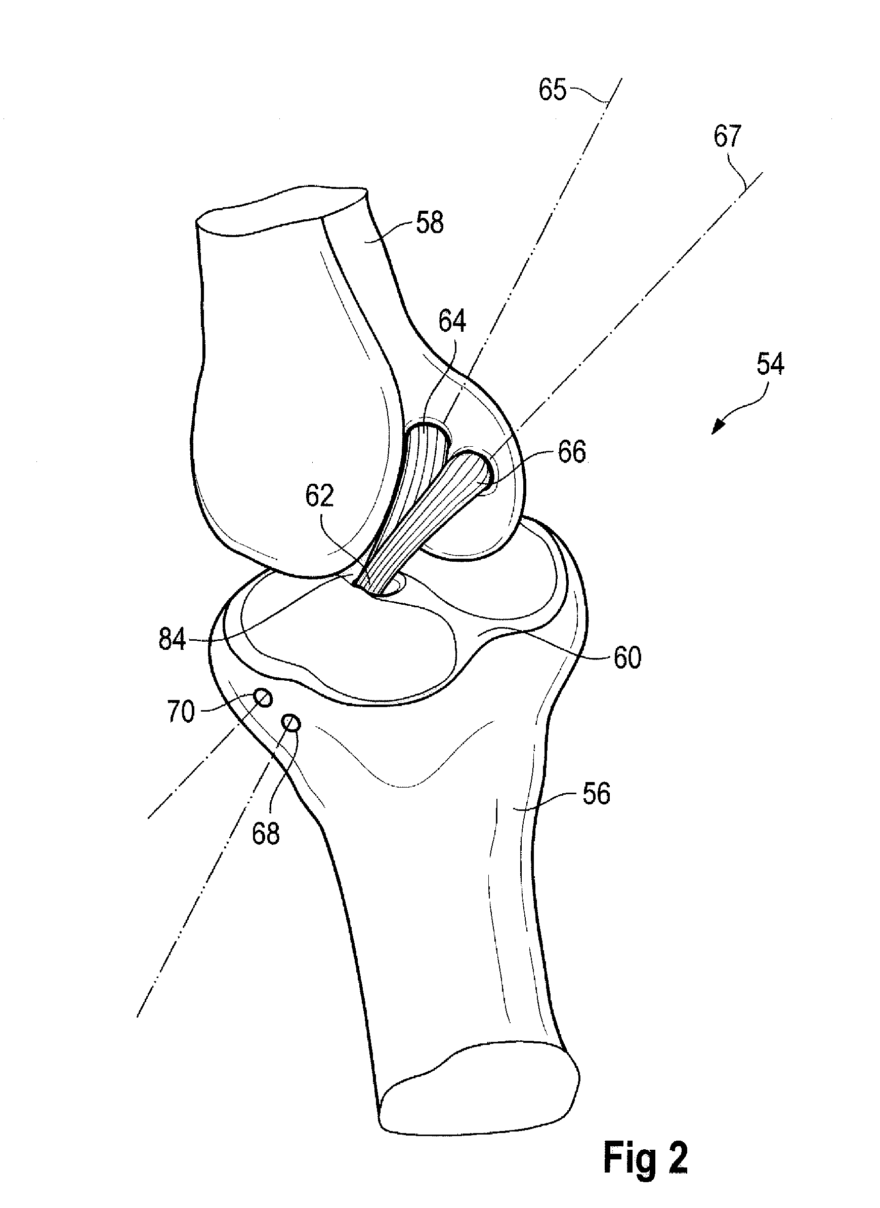 Tibial Aiming Device For The Double Channel Technique