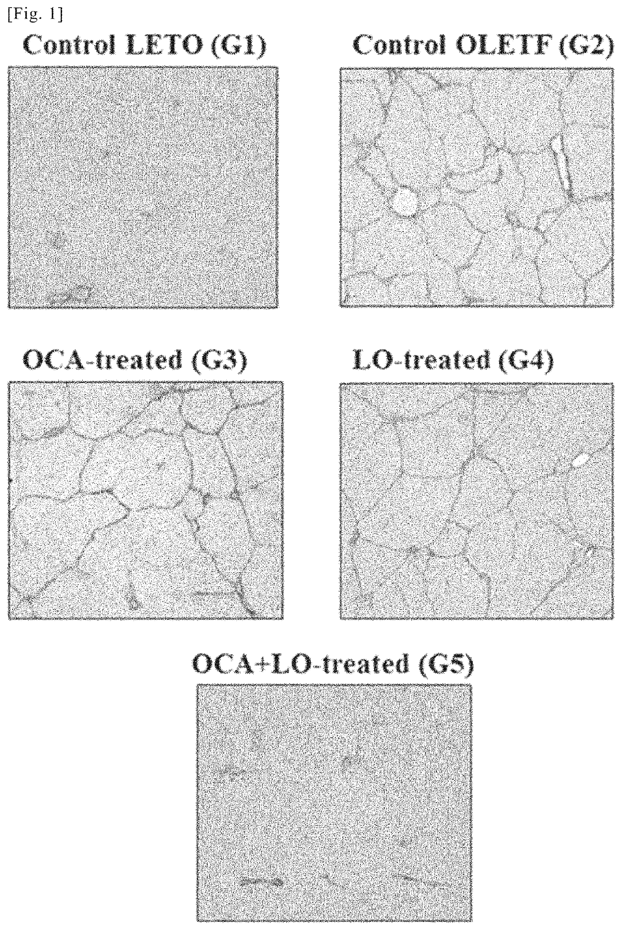 Medicine obtained by combining FXR agonist and ARB