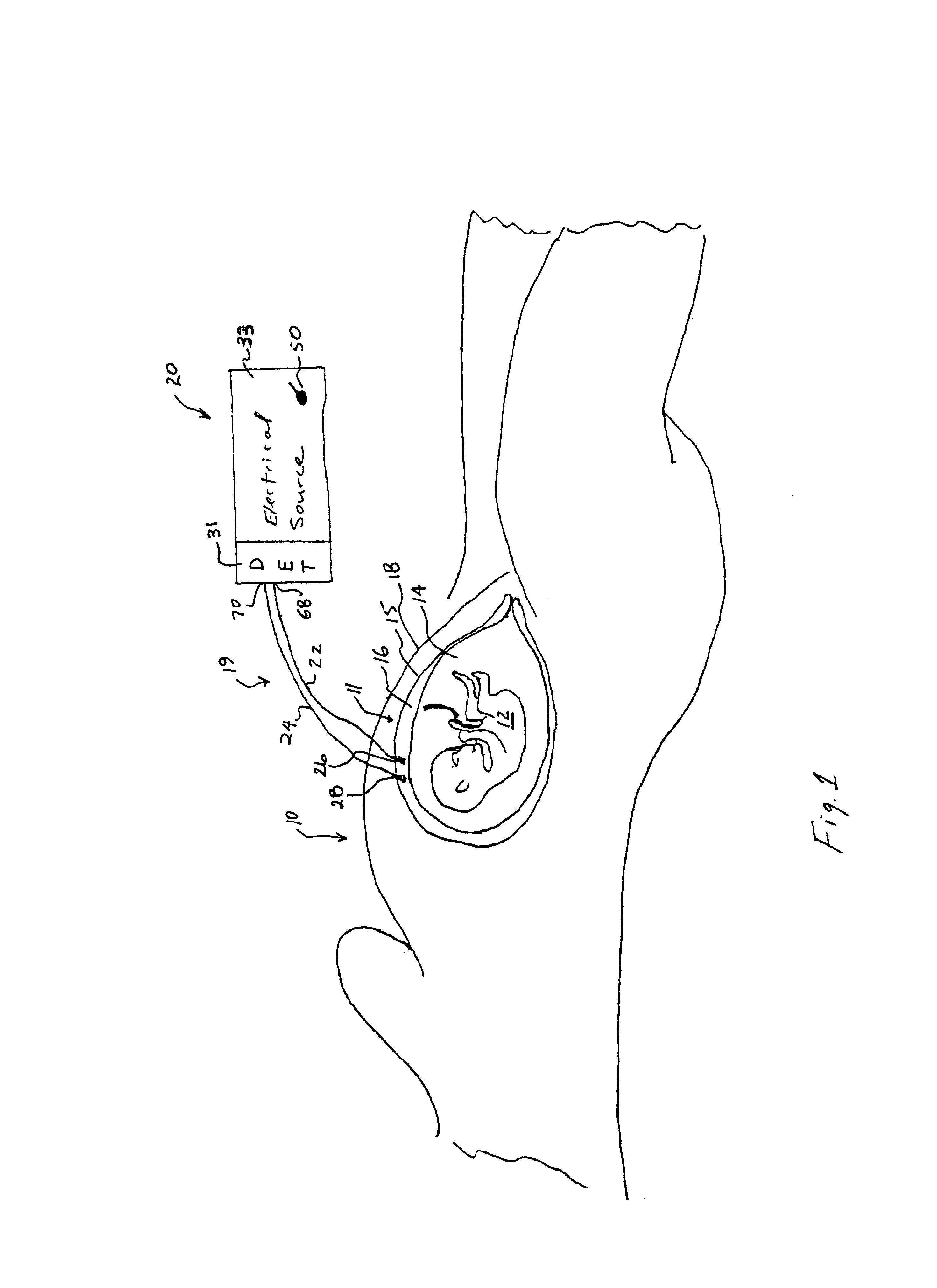 Uterine contraction detection and initiation system and method