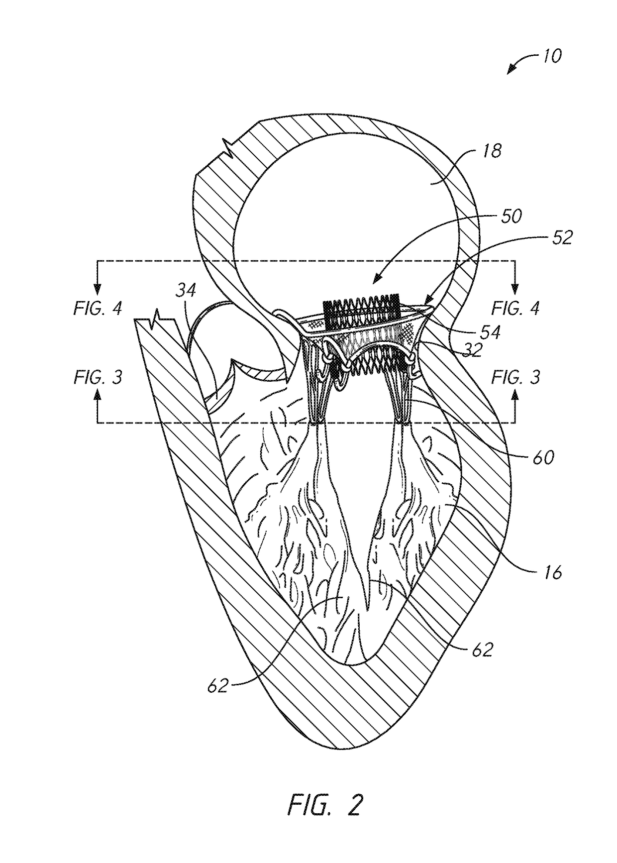 Mitral valve prosthesis delivery system