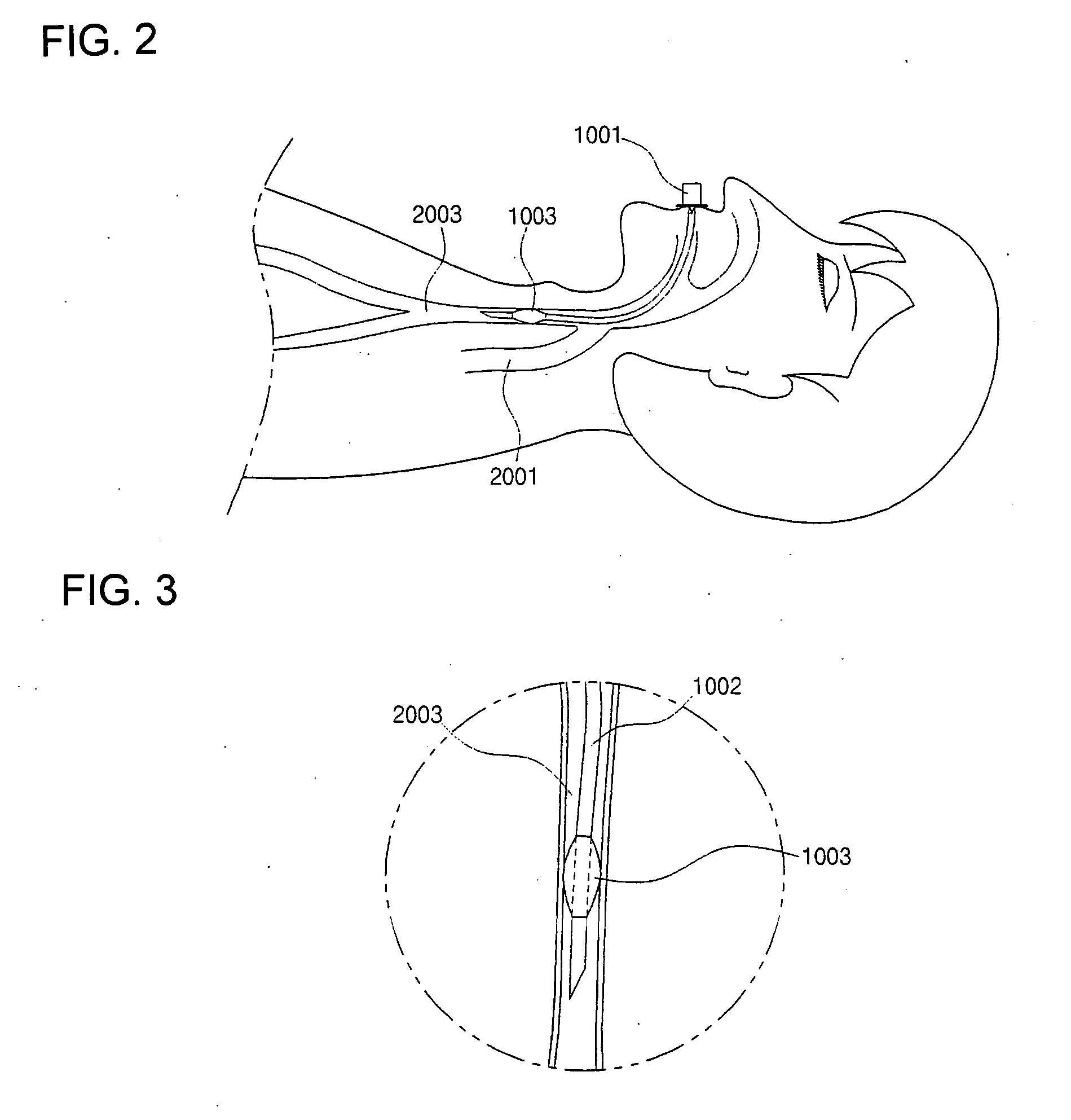 Fixing device for endotracheal tube