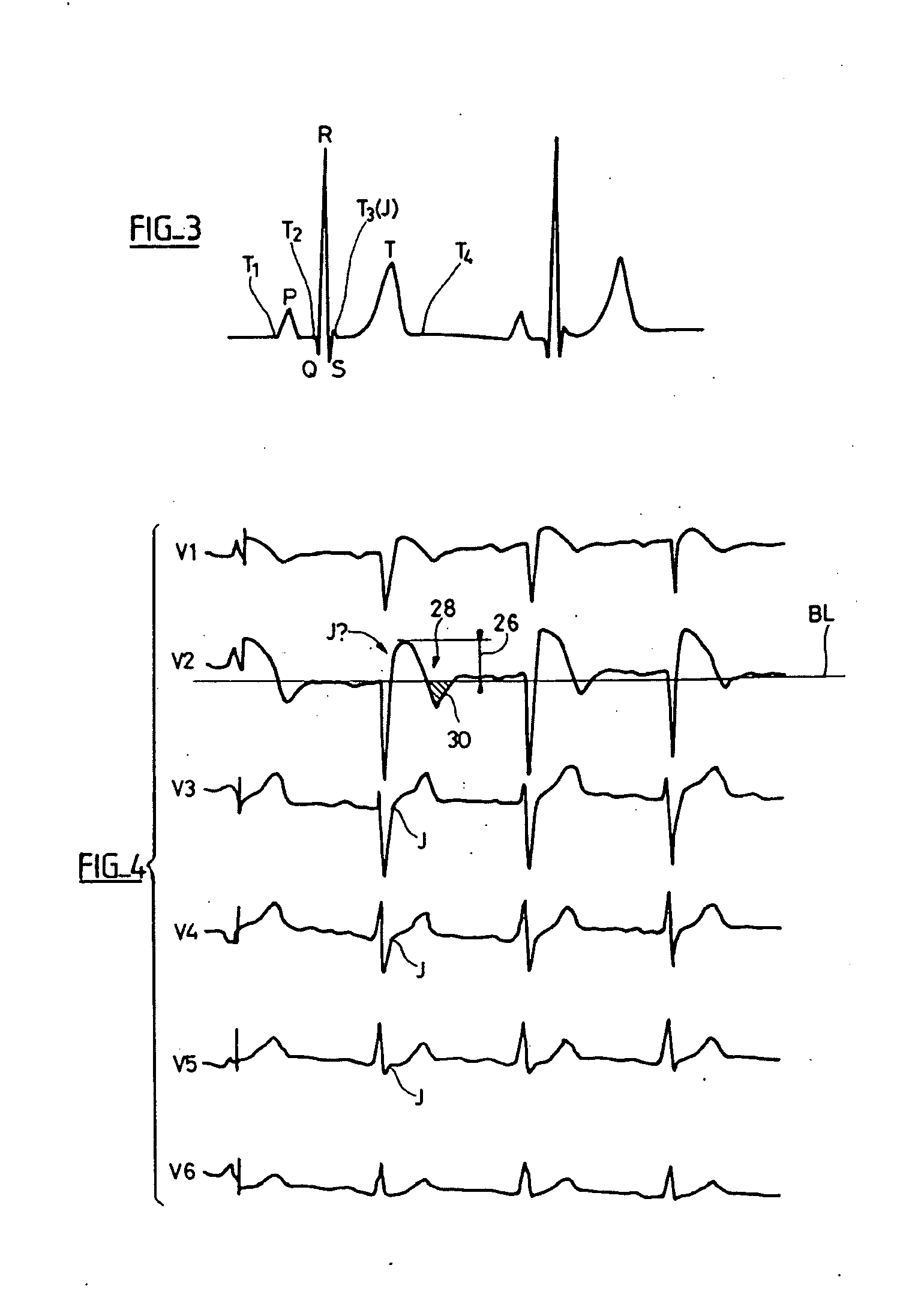 Electrocardiologic device for assisted diagnosis for the diagnostic of brugada syndrome or  early repolarization syndrome