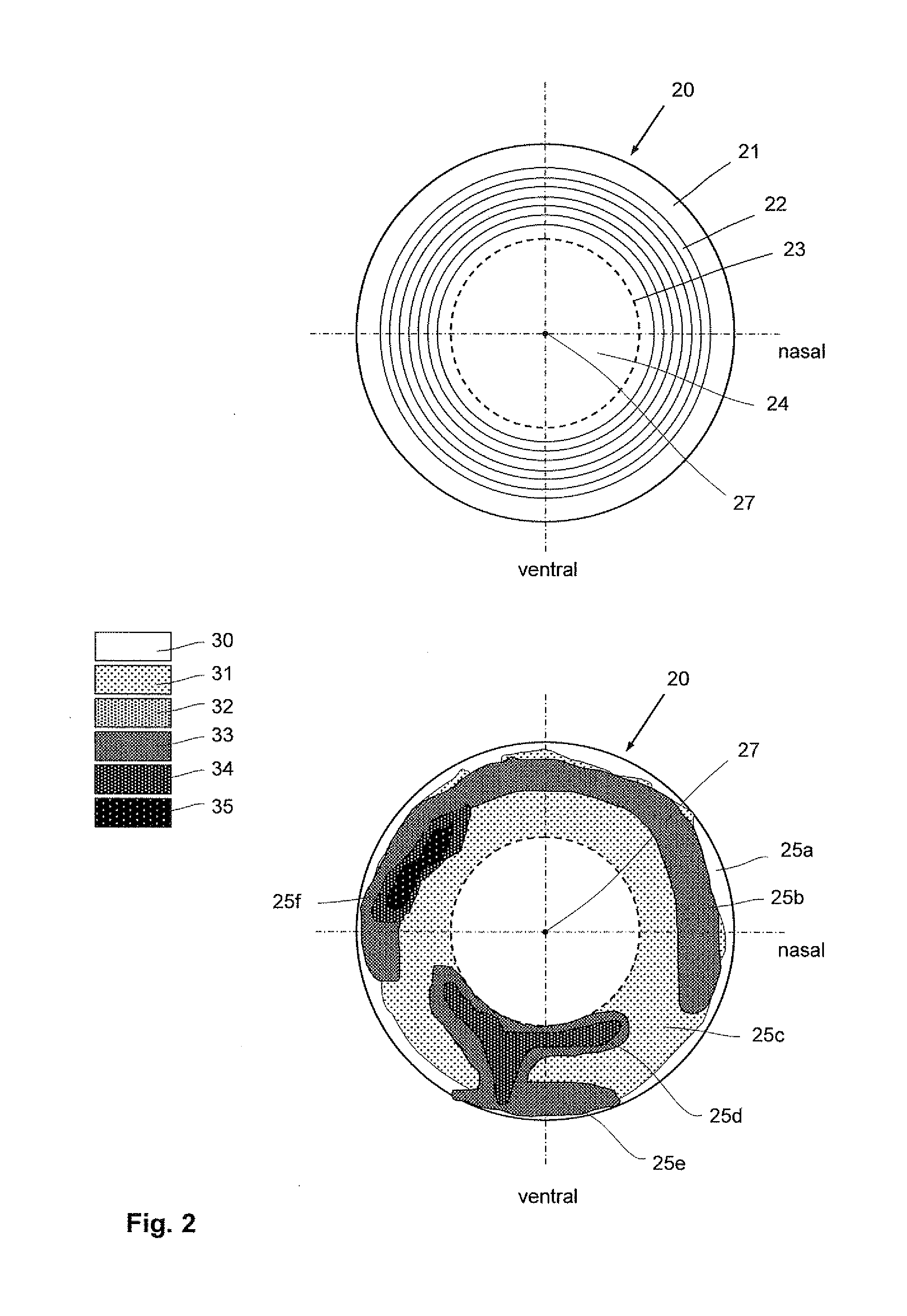 Laser therapy system for noninvasive correction of the refractive system of the eye