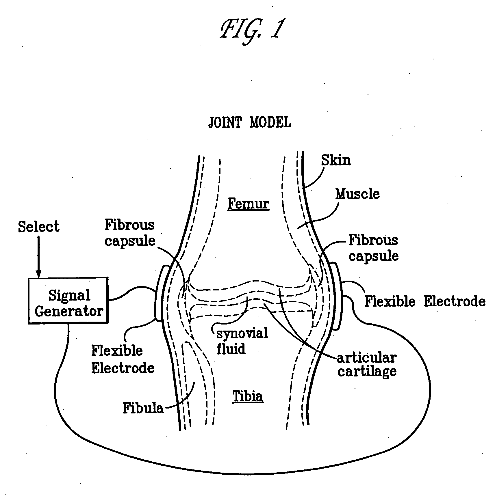Method and device for treating osteoarthritis, cartilage disease, defects and injuries in the human knee