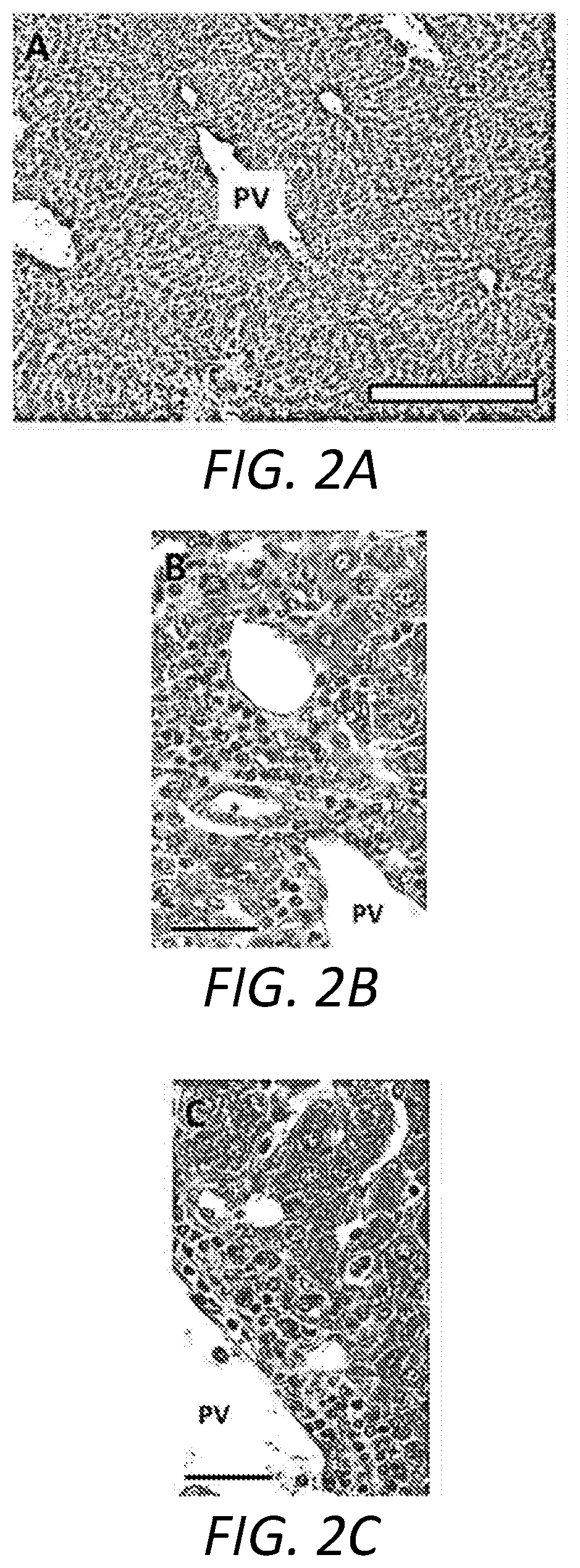 Method for treating primary sclerosing cholangitis