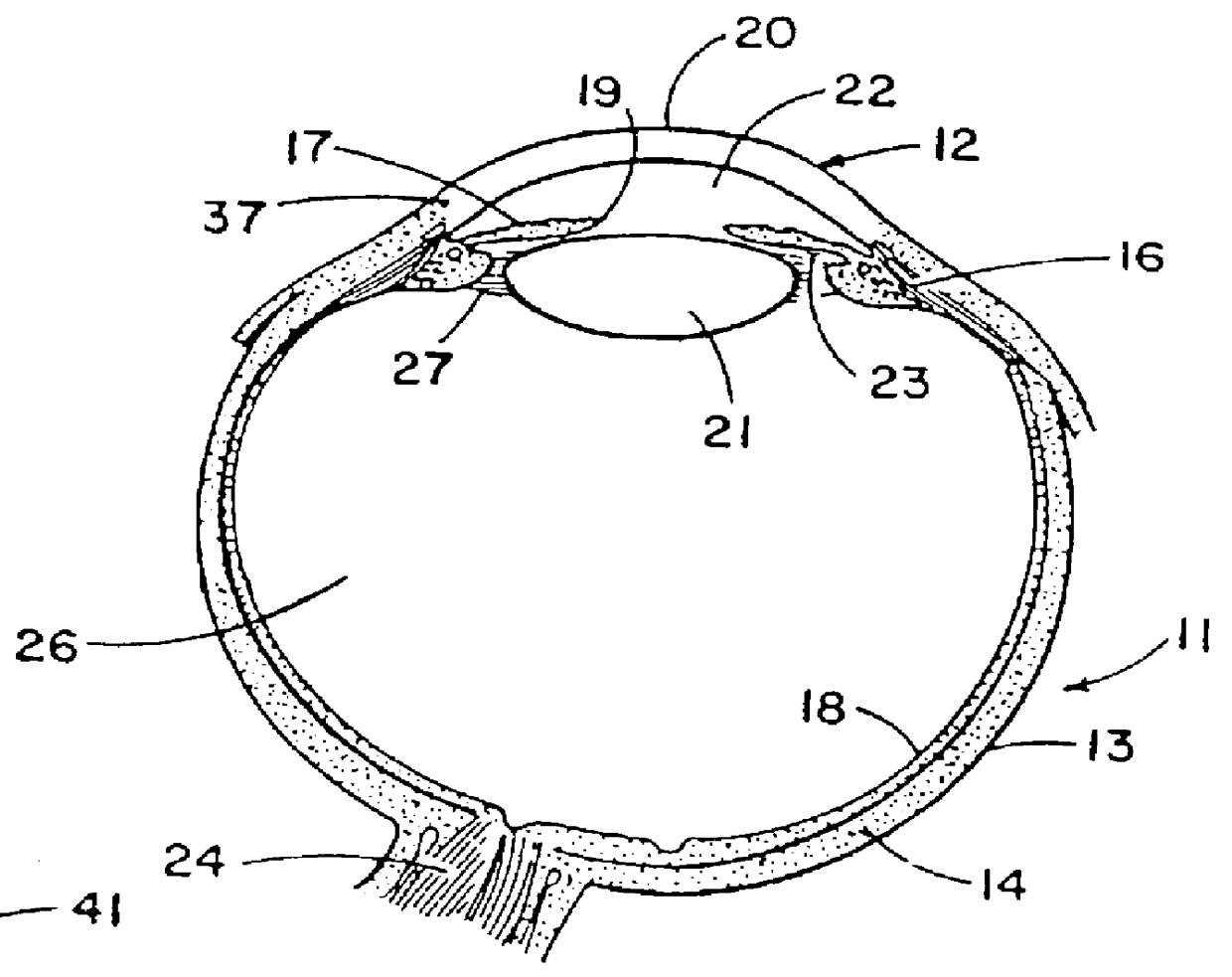 Corneal curvature adjustment ring and apparatus for making a cornea