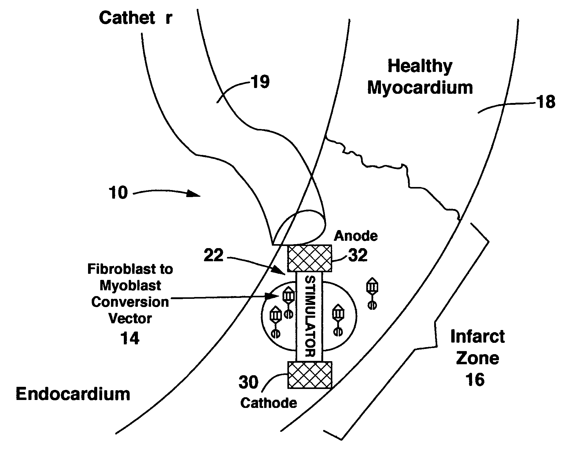 Method and system for myocardial infarction repair