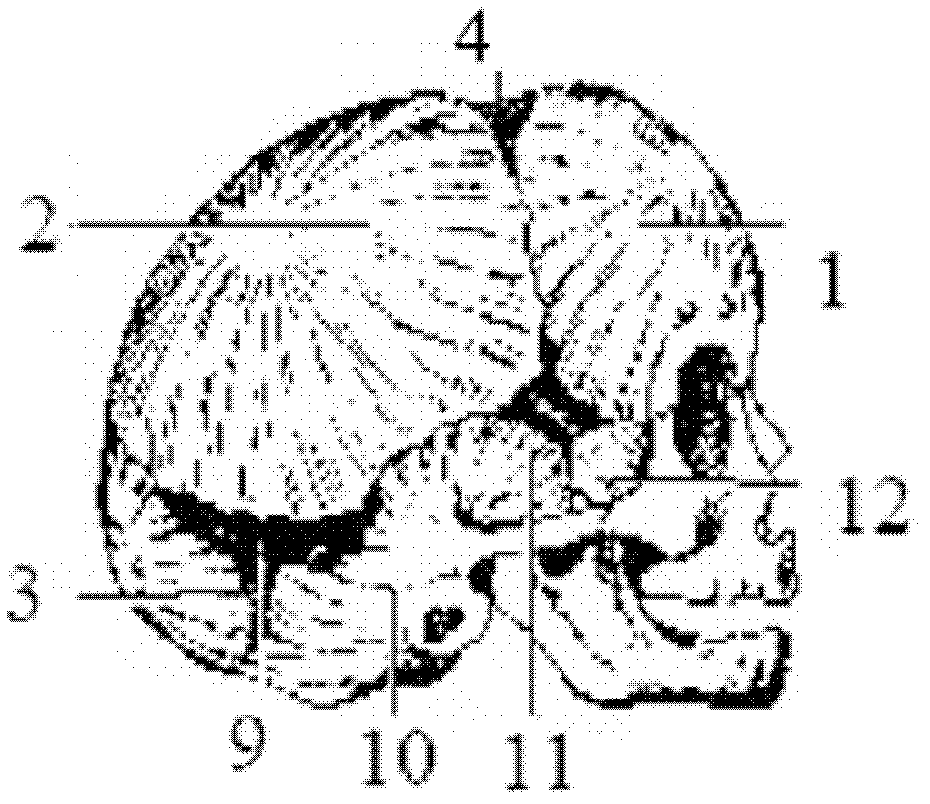 Skull guiding formwork for calvarium reconstruction surgery and manufacturing method of skull guiding formwork