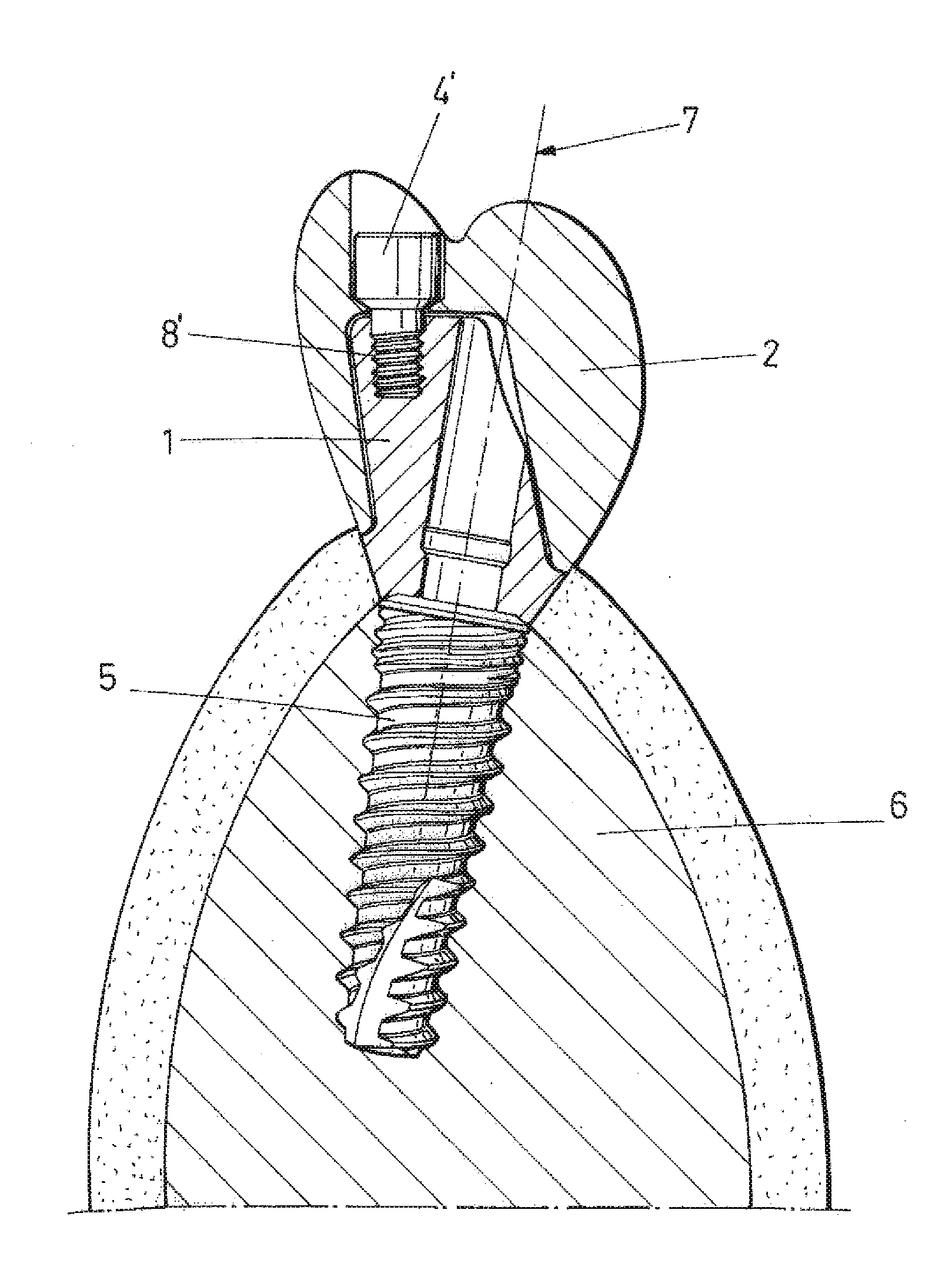 Dental post for supporting dental prostheses and method for the production thereof