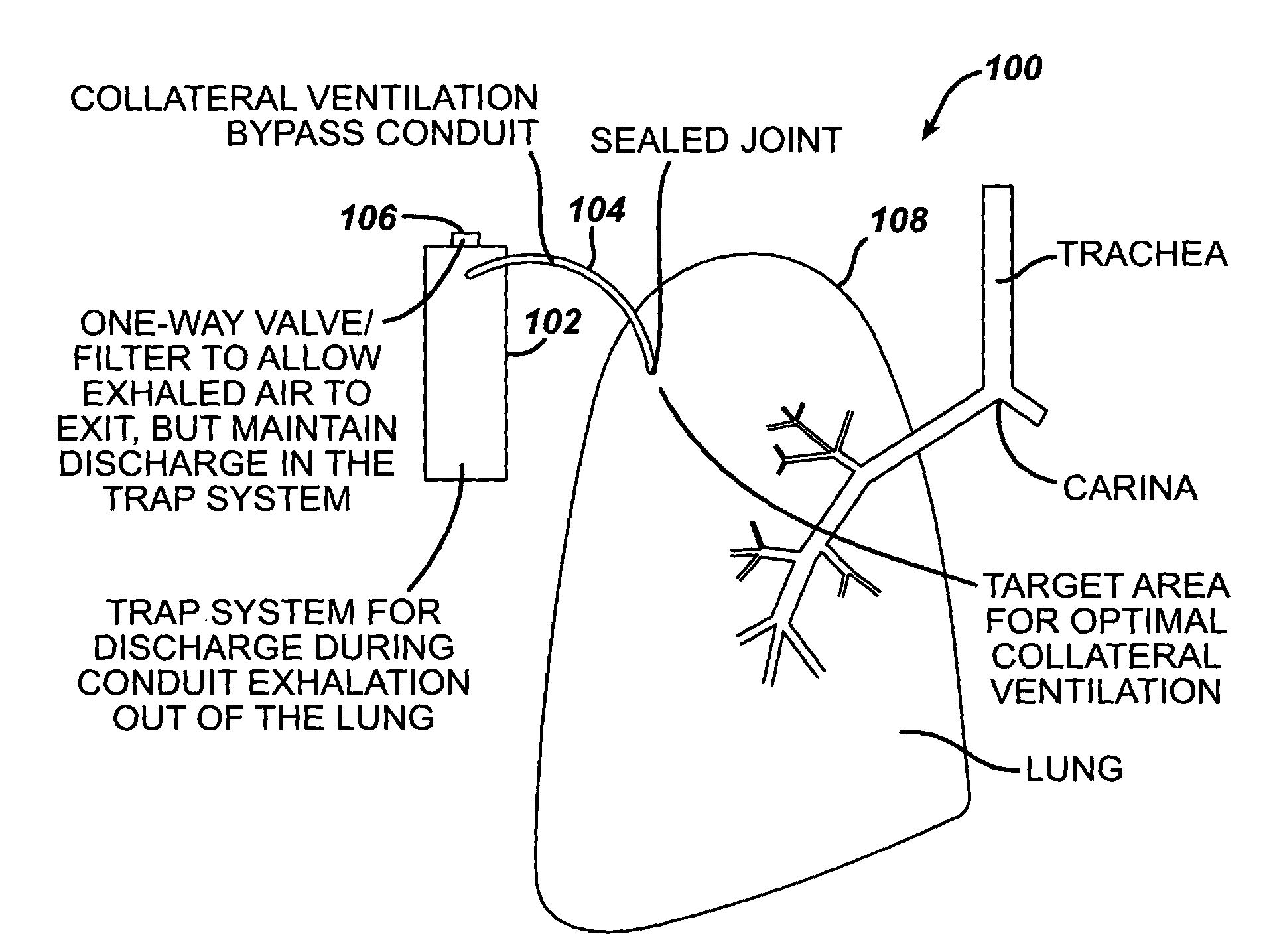 Collateral ventilation bypass system with retention features