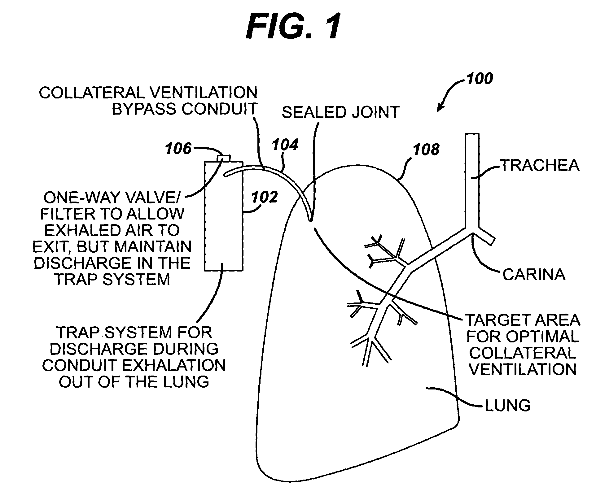 Collateral ventilation bypass system with retention features