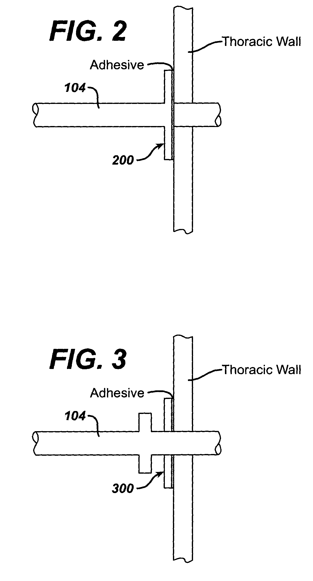 Collateral ventilation bypass system with retention features