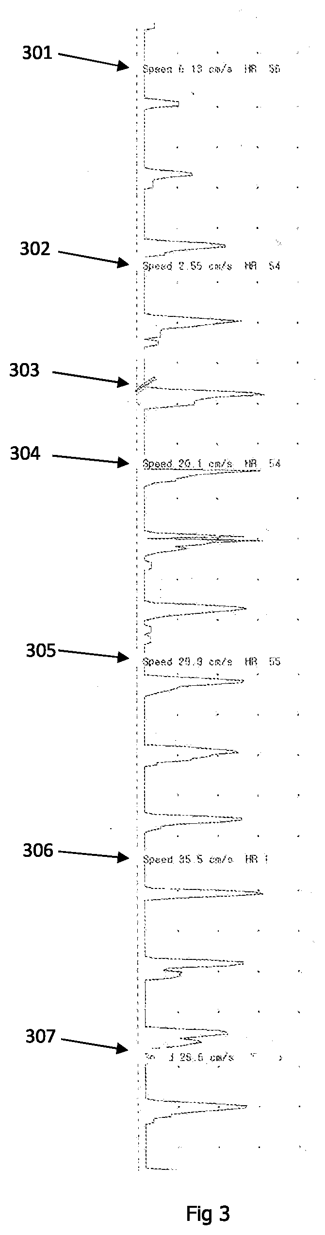 Method and apparatus for improvement of microcirculation