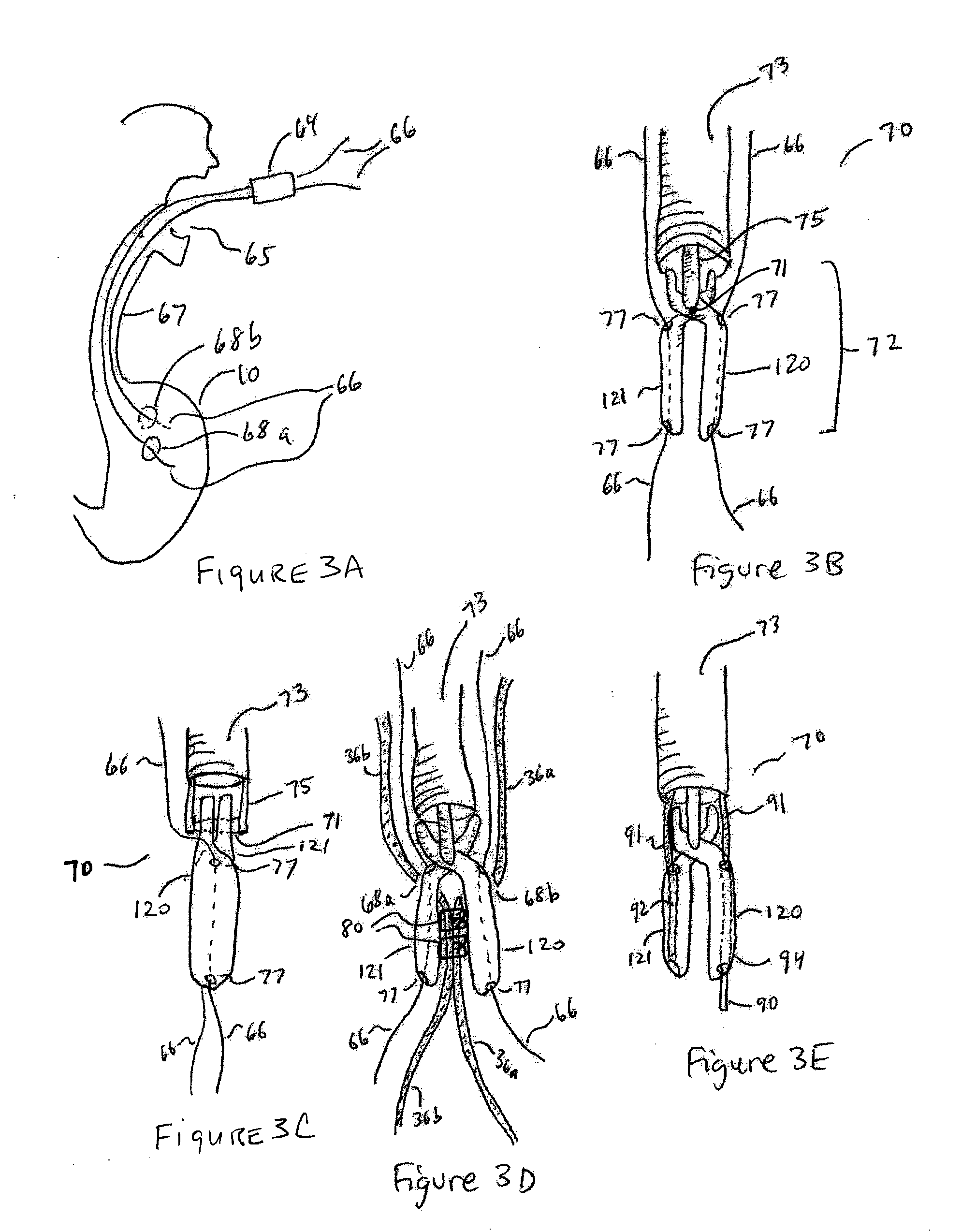 Methods and Devices for Organ Partitioning